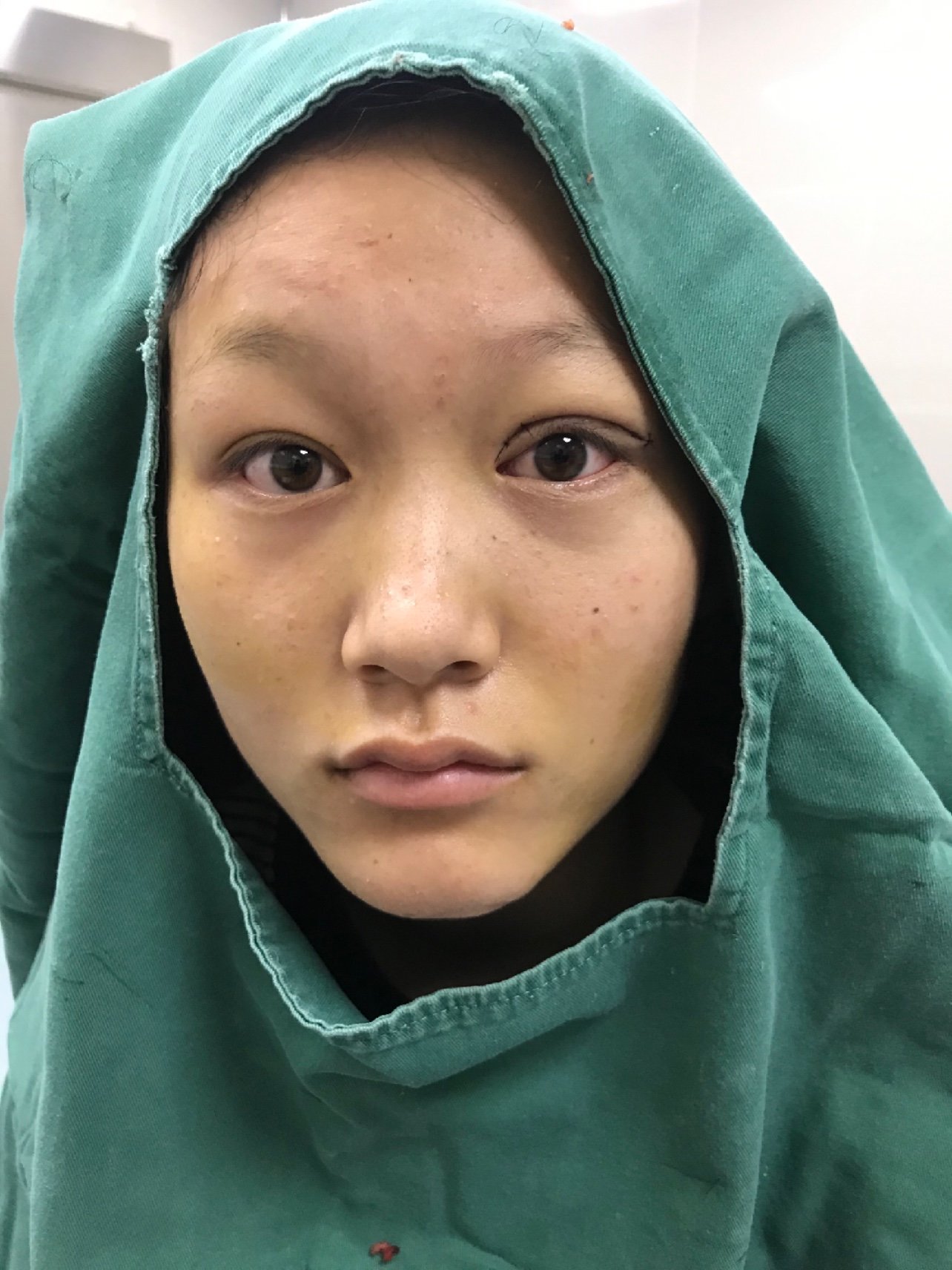 先天上睑下垂手术即刻化蛹为蝶任你飞翔