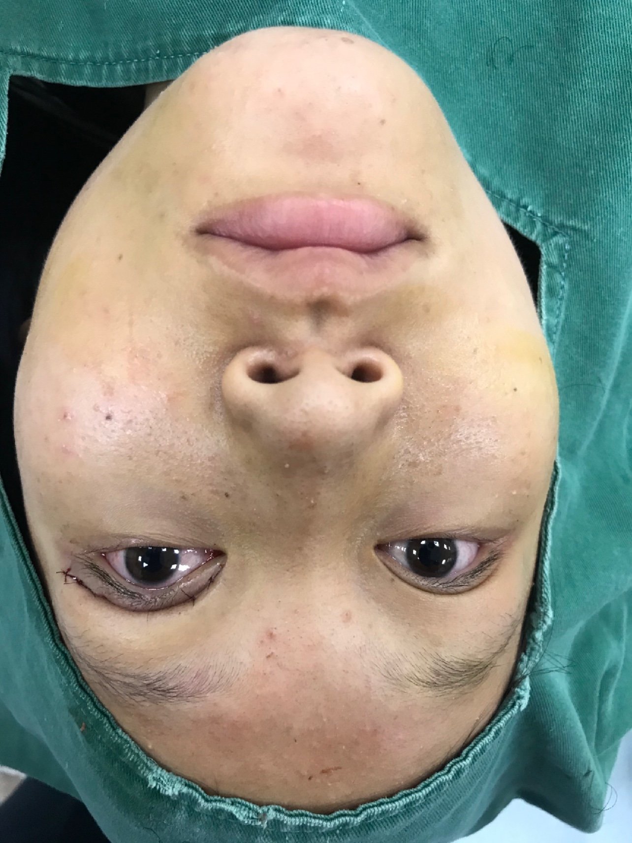 先天上睑下垂手术即刻化蛹为蝶任你飞翔