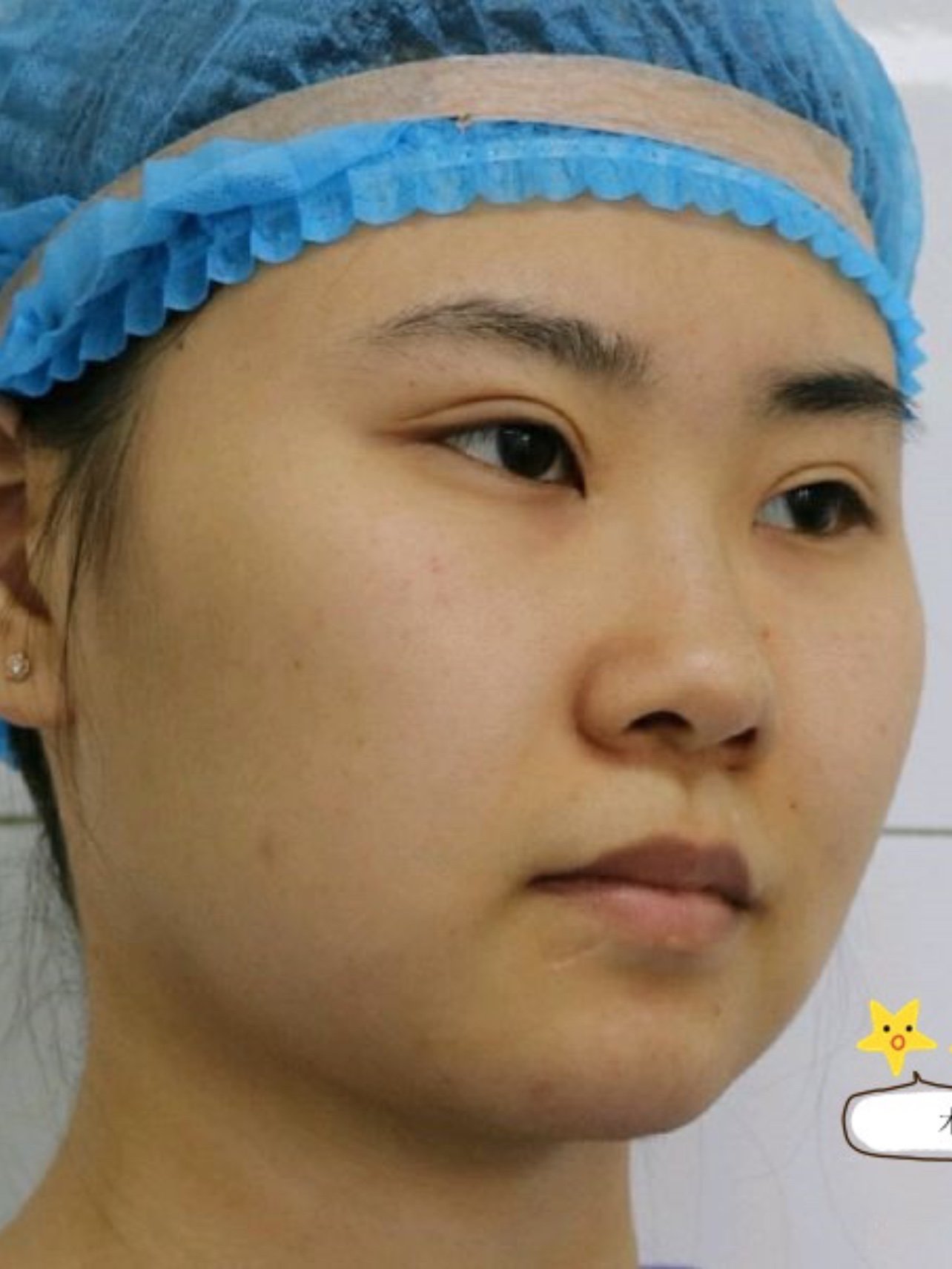 面部吸脂塑形,给你想要的巴掌小脸