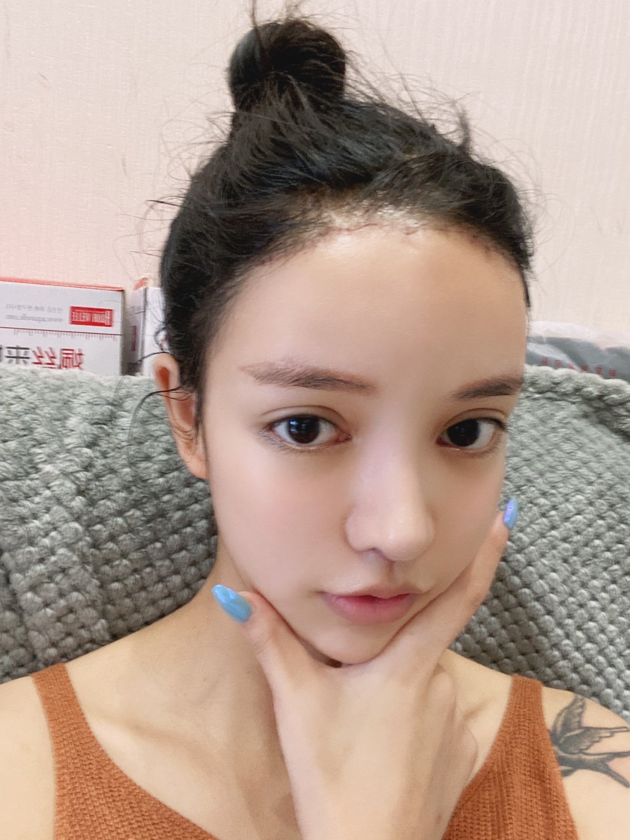 人中缩短77人中沟加深第8天手术医院:北京东环亦美整_圈子-新氧美容