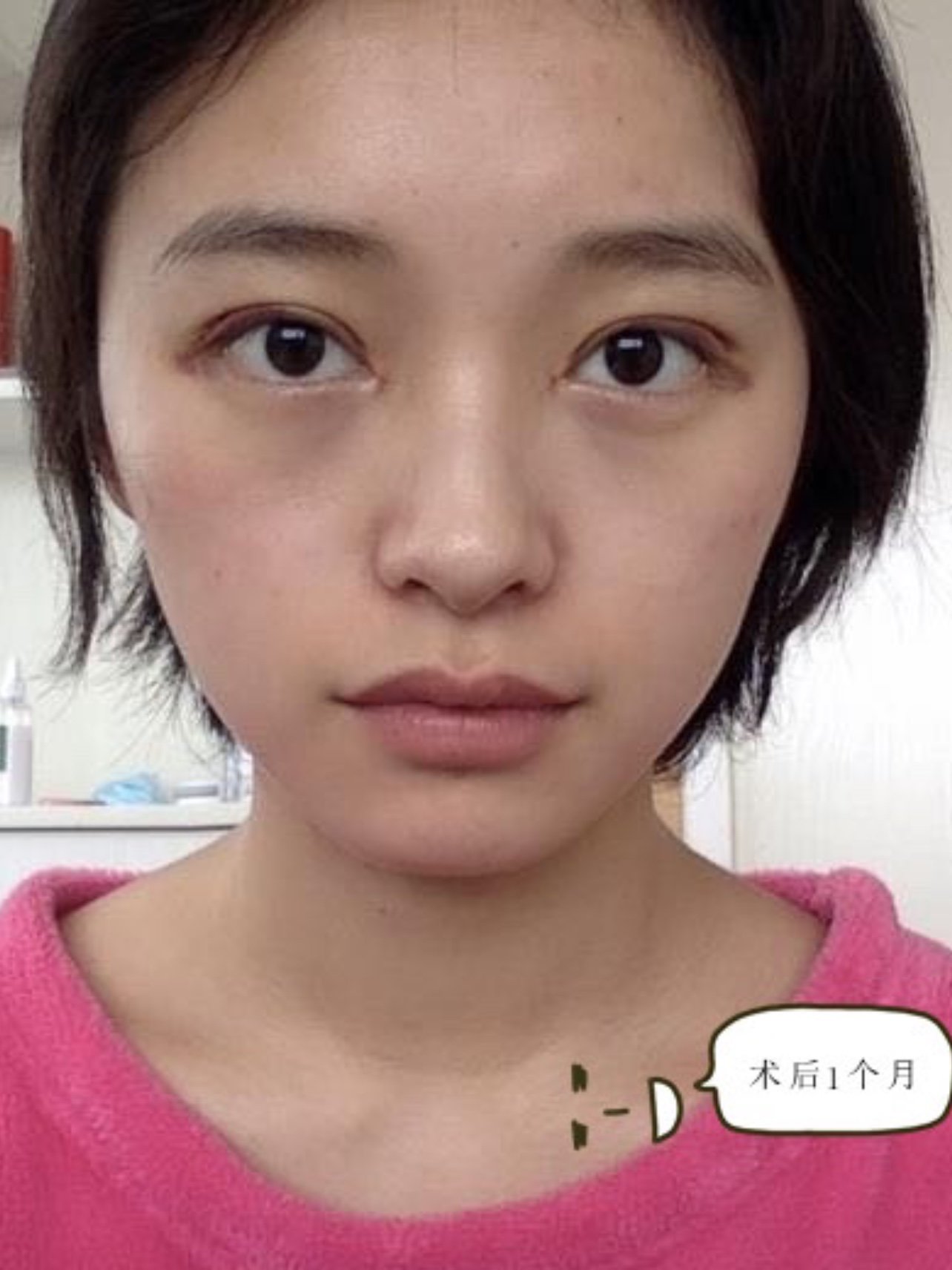 论双眼皮类型,那种更适合你!