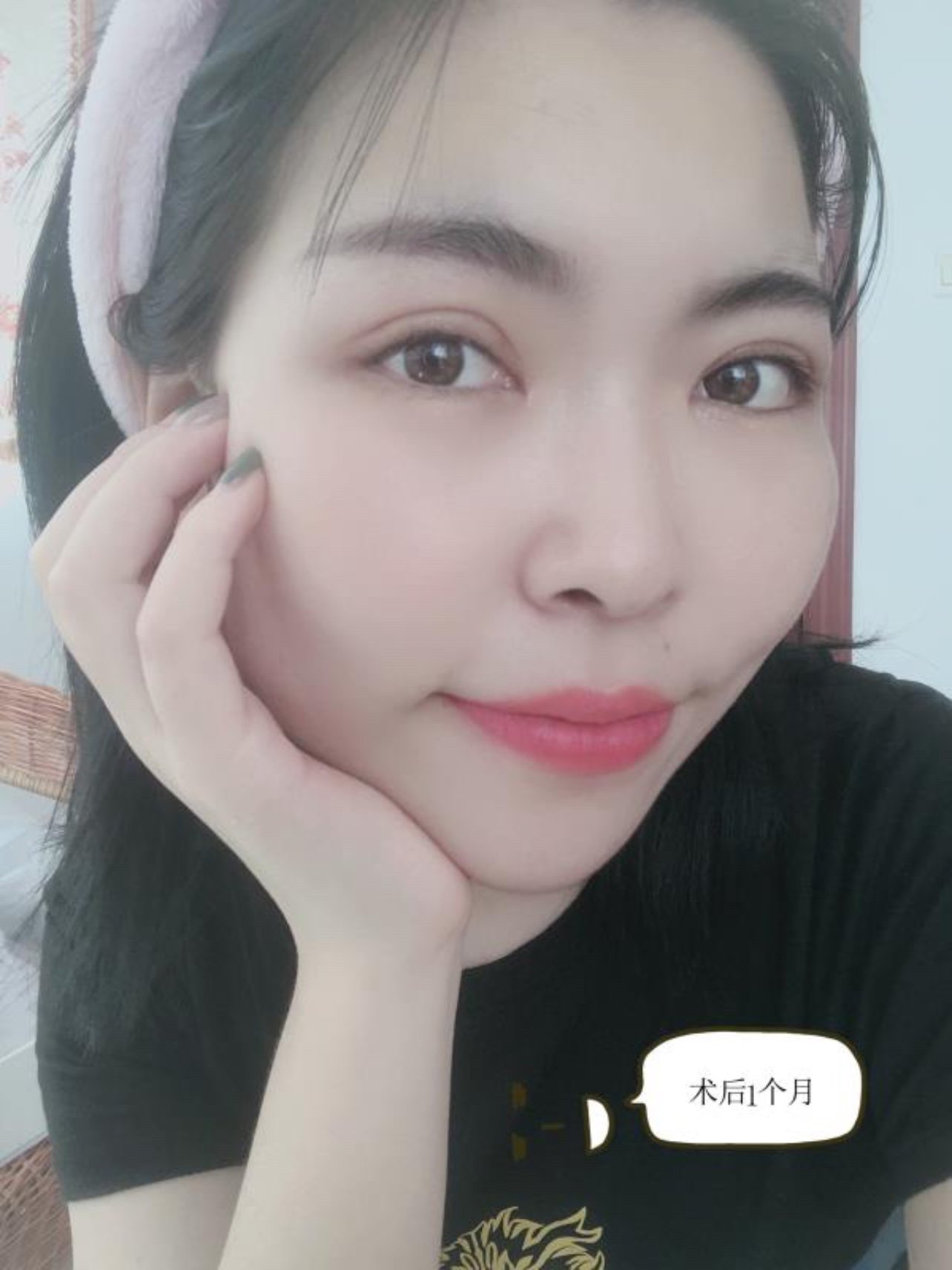 三眼皮,多眼皮还有救吗?