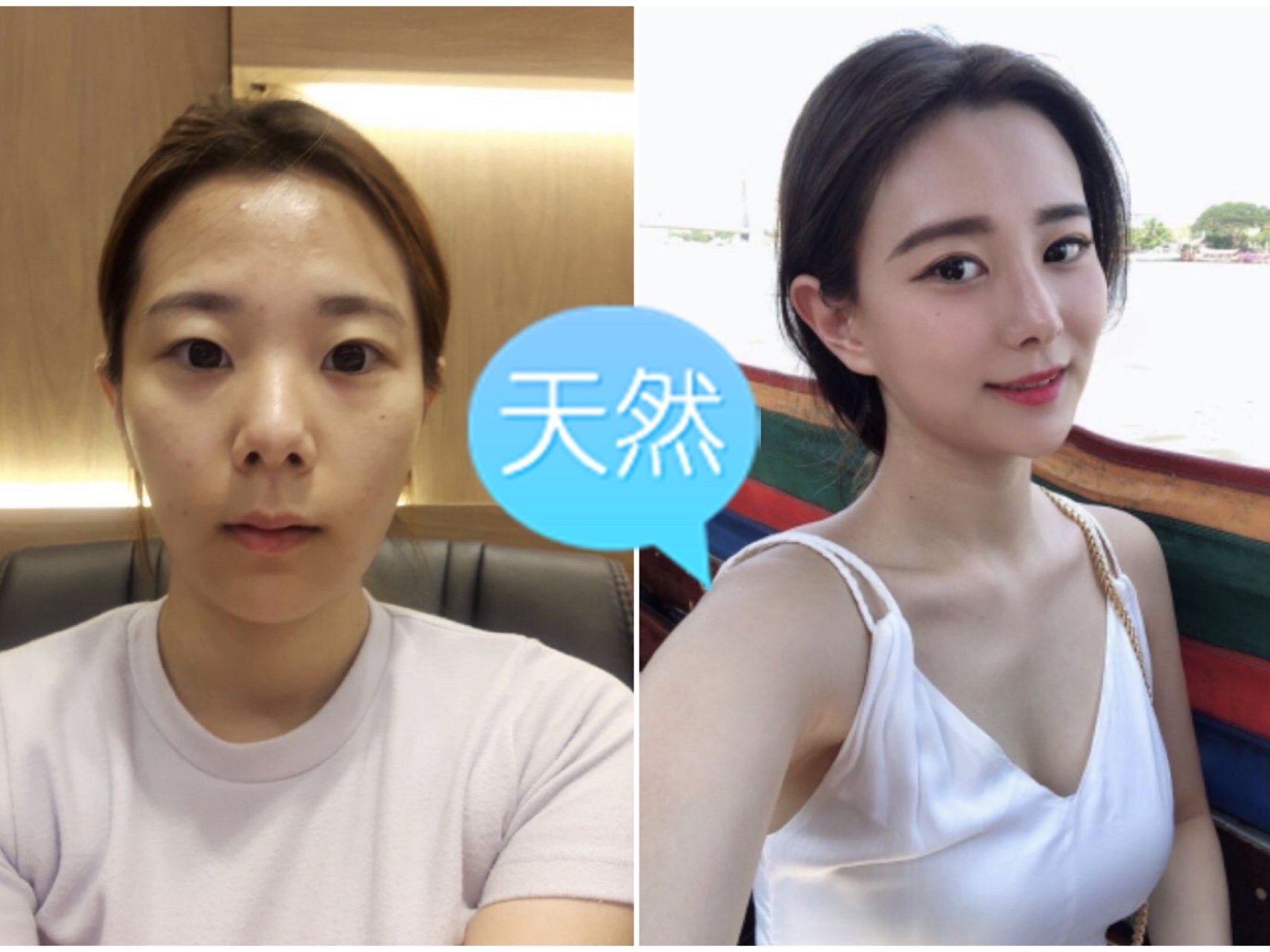 鼻翼整形大概多少钱_鼻翼整形术_鼻翼整形手术