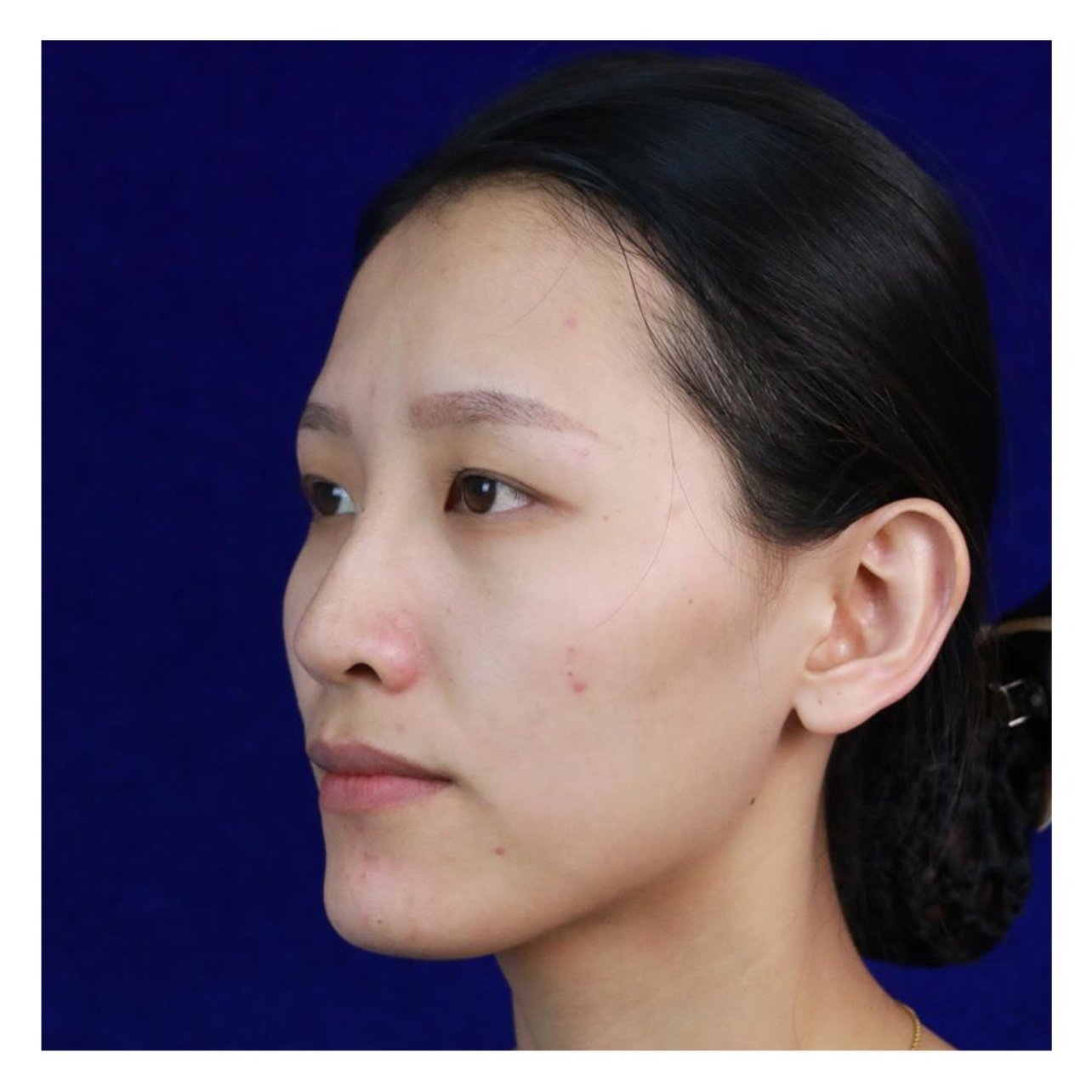 面部97个人感受:面部凹陷有点严重,看上去真的挺显老_圈子-新氧美容