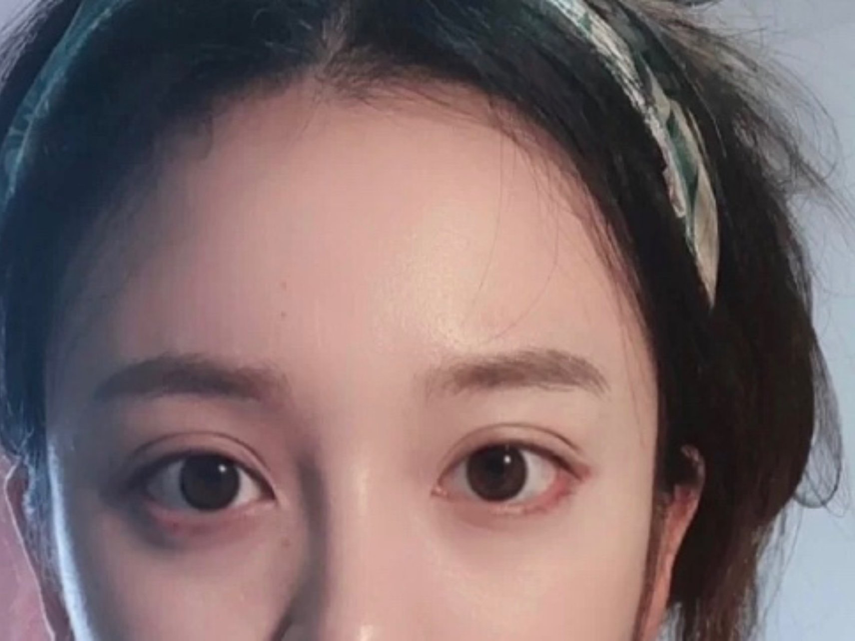 做的眼部多项加眼尾下至,以前眼尾有点上挑,做了下至后好看多