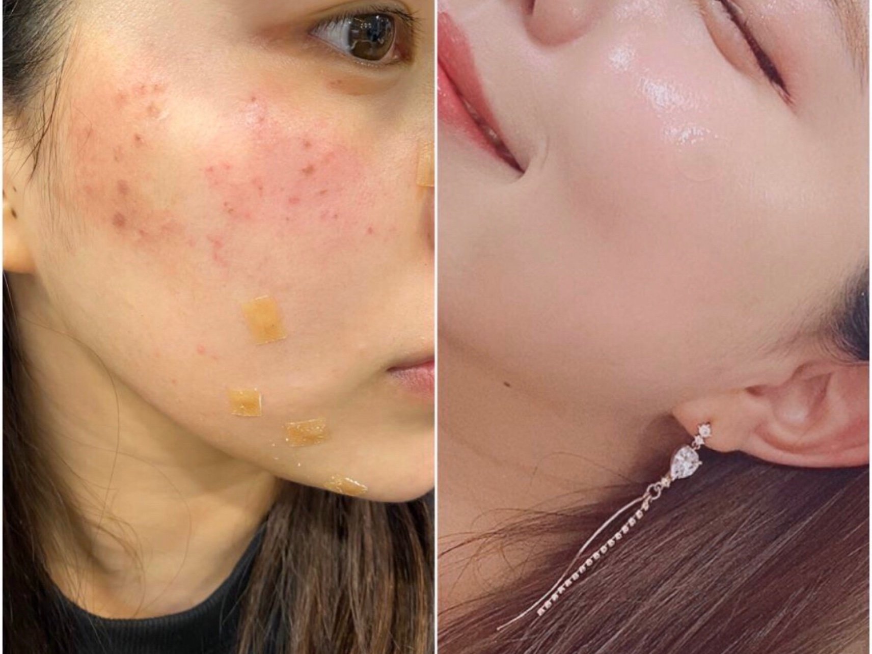 去痘印脸上没有痘痘痘印!甄颜做的疤痕还有微针效果实在太好了!