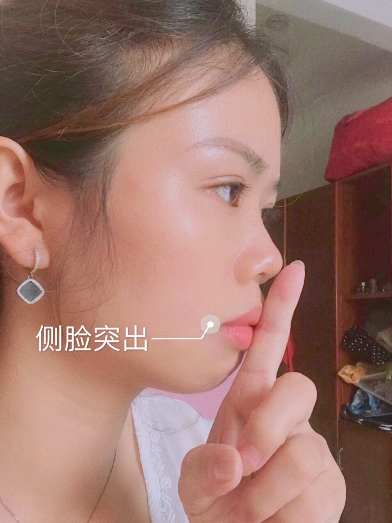 龅牙戴牙套前后对比戴了牙套感觉下巴出来一点点72