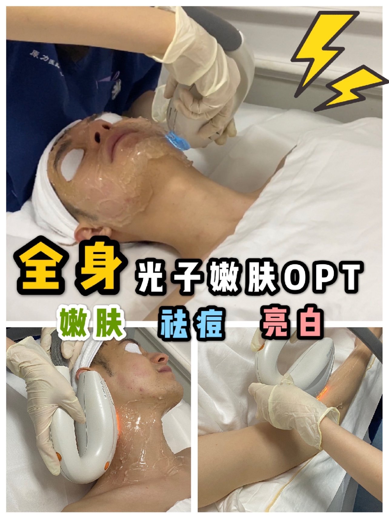 打卡:全身光子嫩肤opt,aopt