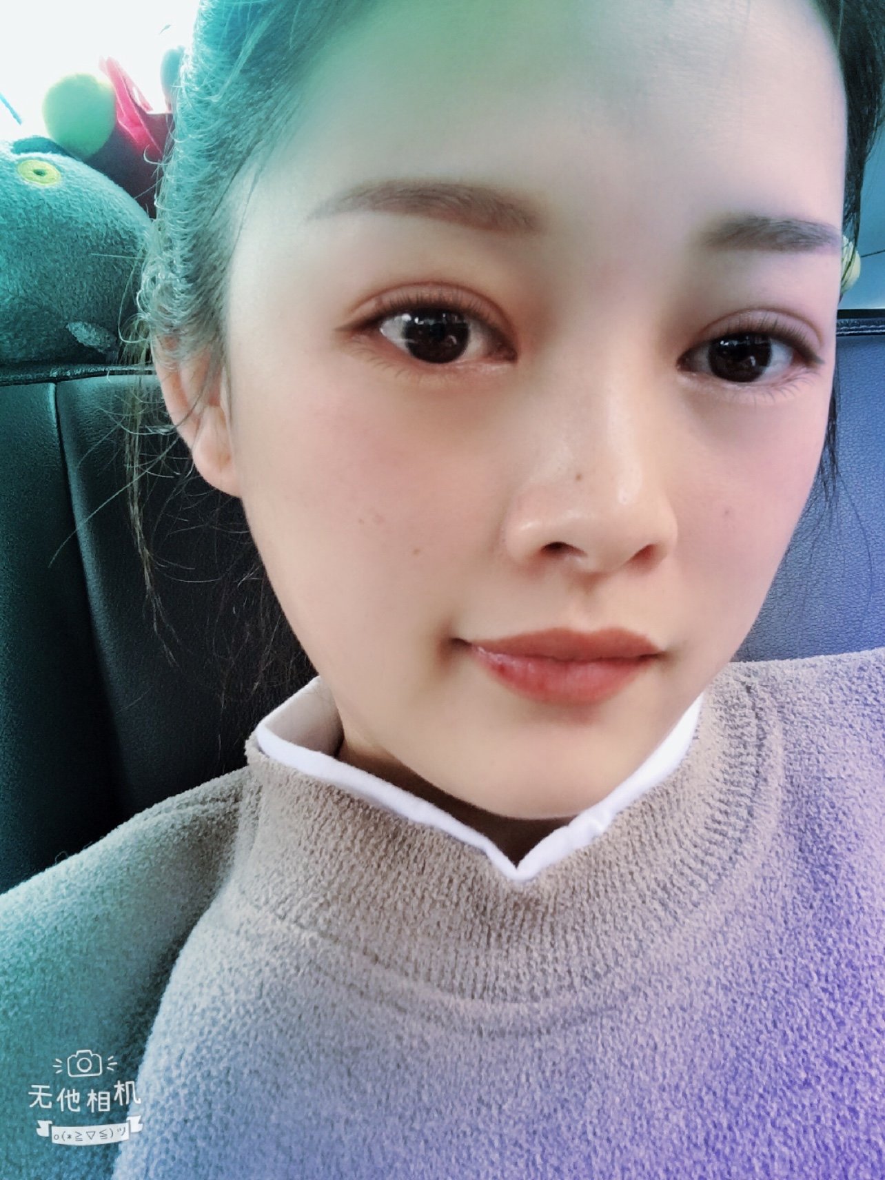 长沙申美全切双眼皮术后一个月一星期