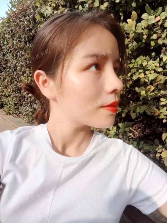 97凸嘴 面部凹陷,只靠一招逆袭,7815do出高级"混_圈子-新氧美容