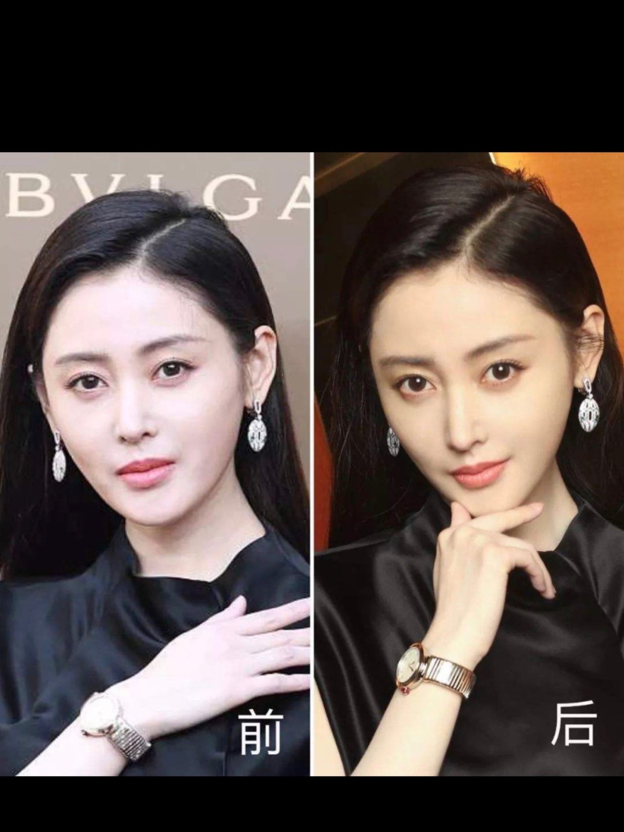 张天爱为什么想不开做了窒息鼻