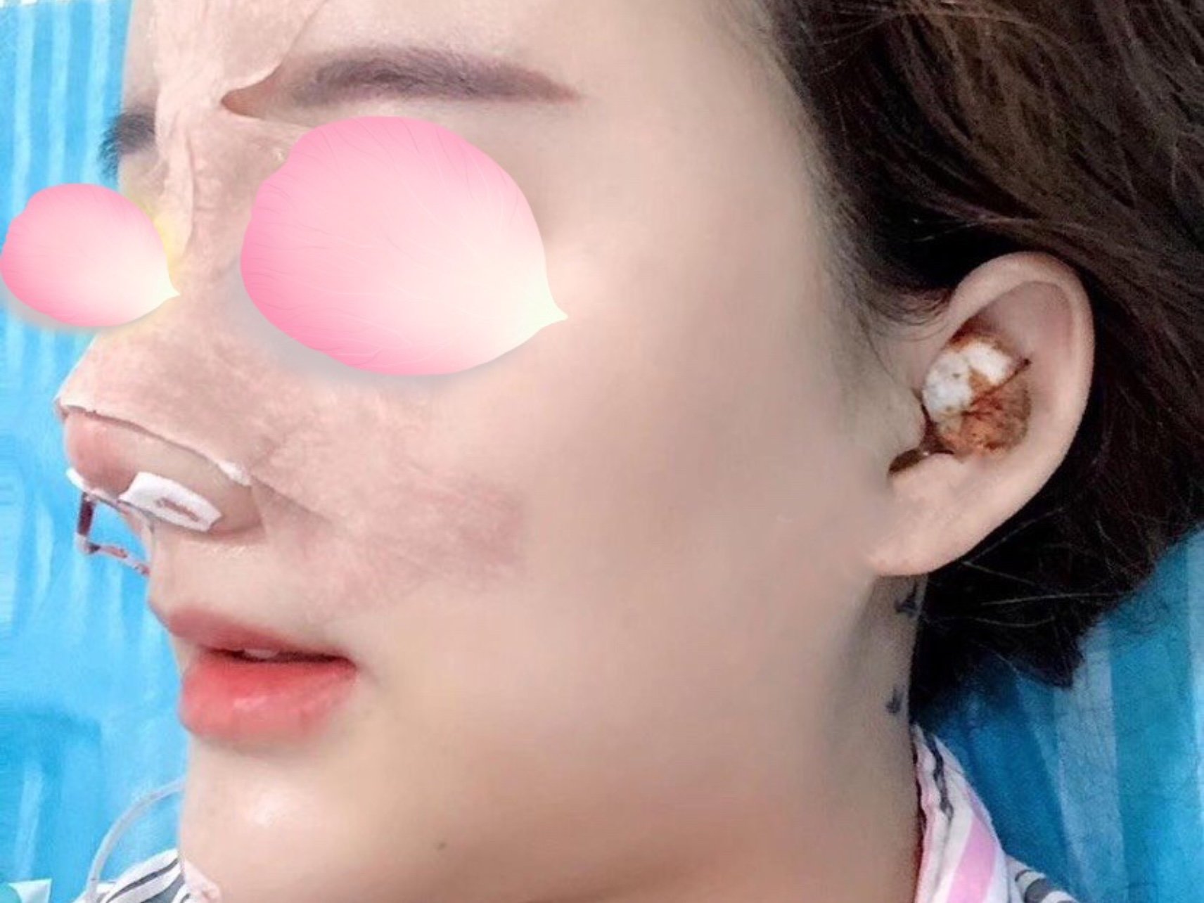 两年前做了线雕隆鼻,但是做完后我鼻子没有型,反正就_圈子-新氧美容