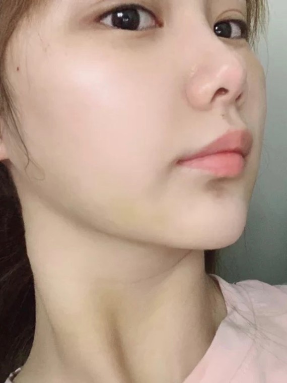 面部吸脂 这是手术的第十天,看到我打了两个圈圈的地方了吗,本来脸上