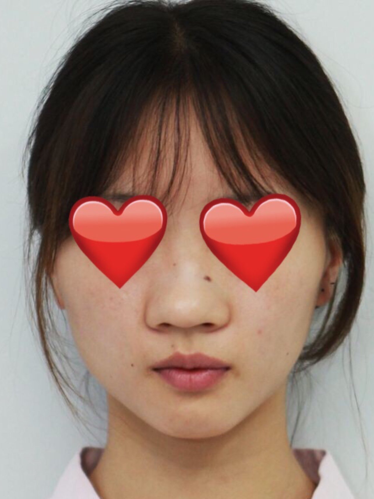 因为鼻子91又扁又大,很丑,所以只能来整形鼻子了.