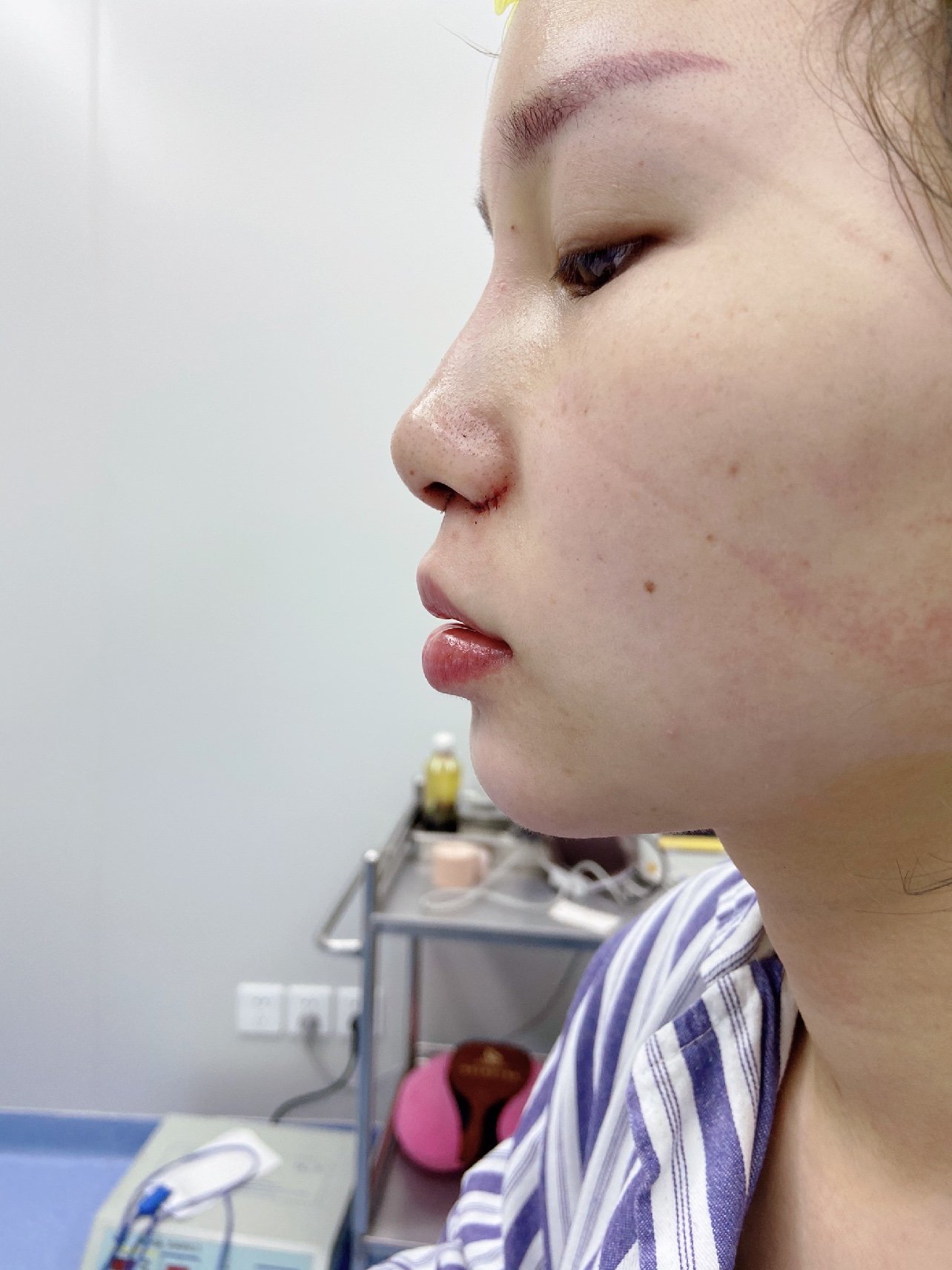 就因为自己没有人中沟,所以稍微显得比同龄人老了那么_圈子-新氧美容