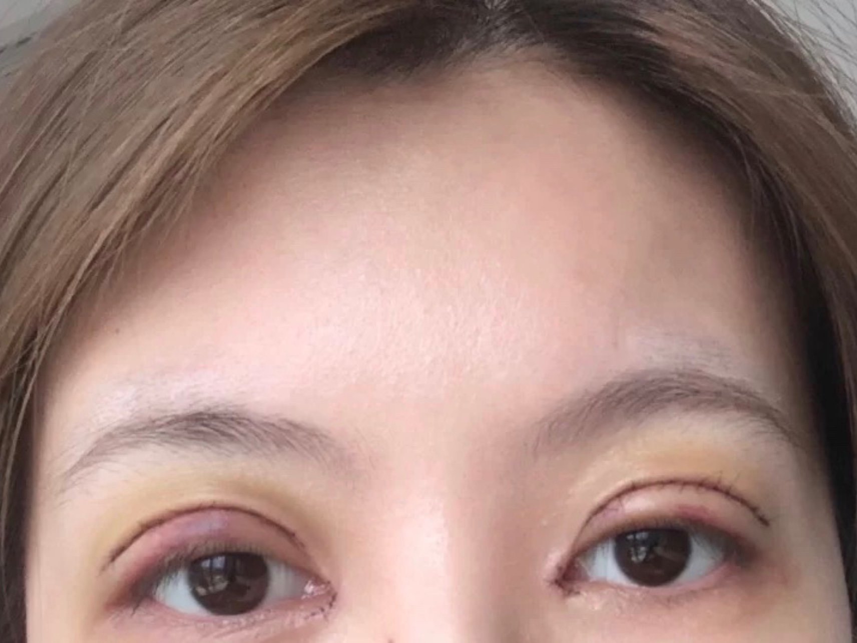 切开双眼皮这是我手术第一天第二天第三天第四天的照片_圈子-新氧美容