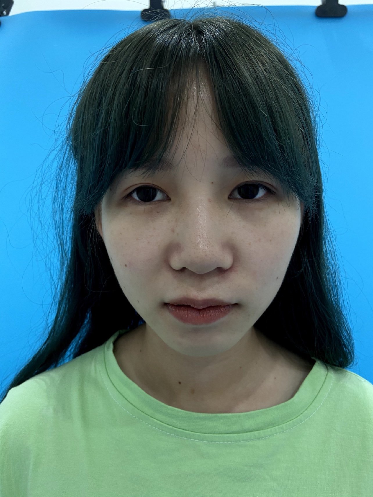 就因为自己没有人中沟,所以稍微显得比同龄人老了那么_圈子-新氧美容