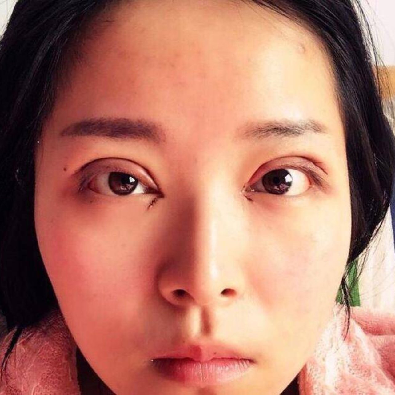 小眼睛进阶之路 | 谁说割的双眼皮就一定看着像假的!