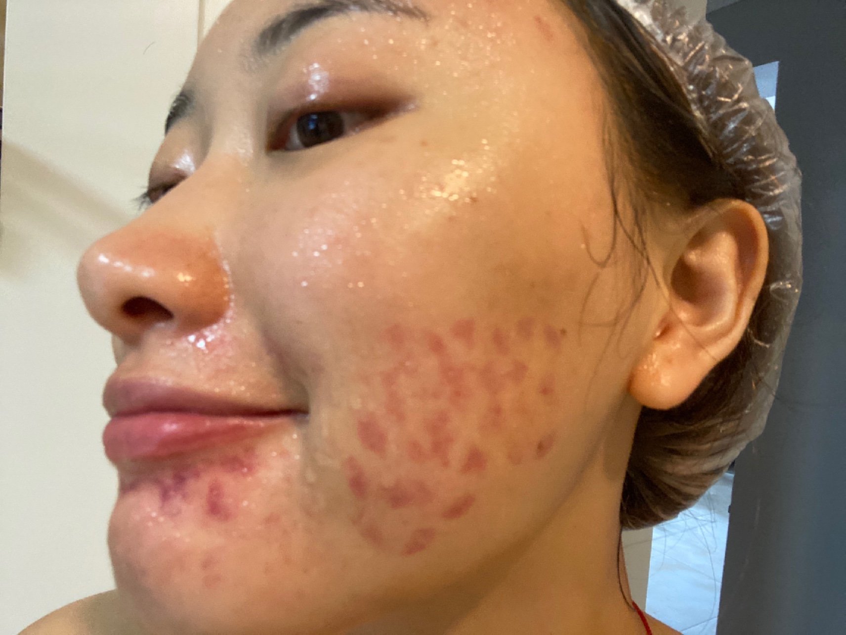 自己打完水光就这样了,不解.