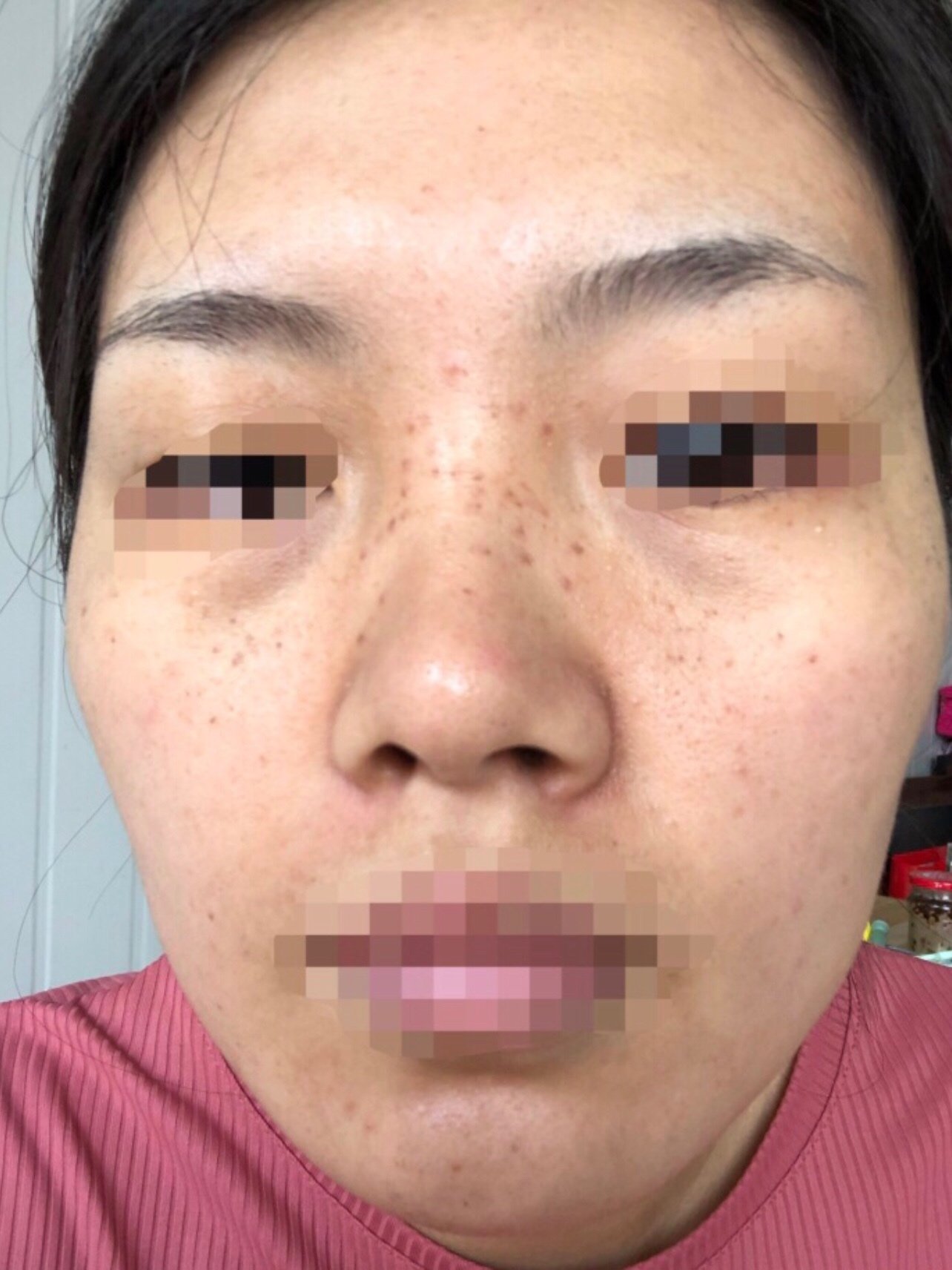 长期睡眠不足带来了黑眼圈雀斑肤色暗沉甚至唇炎.