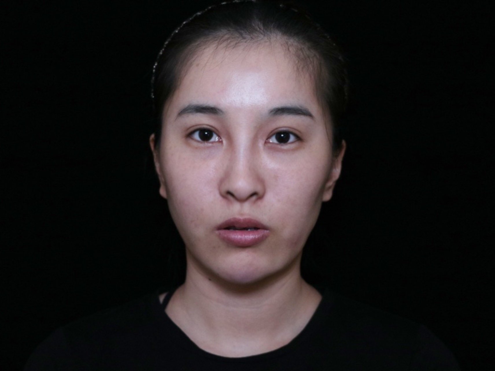 每次看到突出的大腮帮子,就特别的烦,脸好大啊,看身_圈子-新氧美容