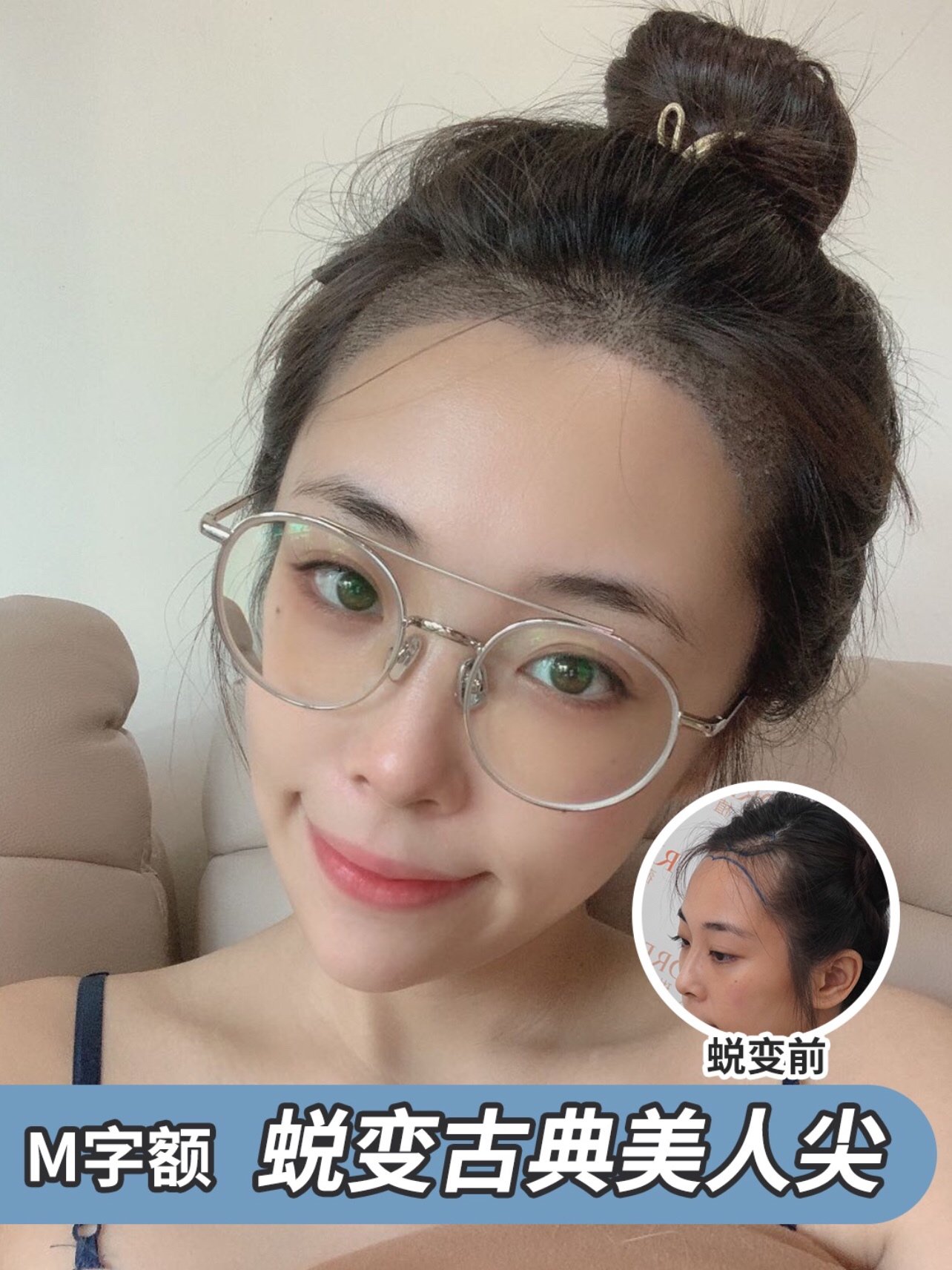 93m字额,蜕变古典美人尖90 9799做植发手术前的我: