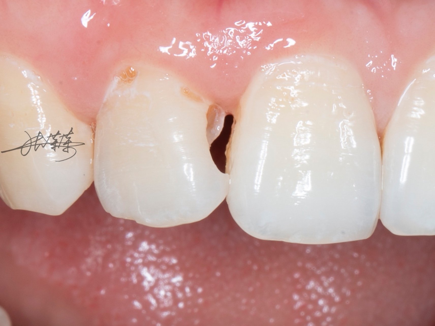 美牙爱美的你一定不想让自己的门牙补成丑丑的样子