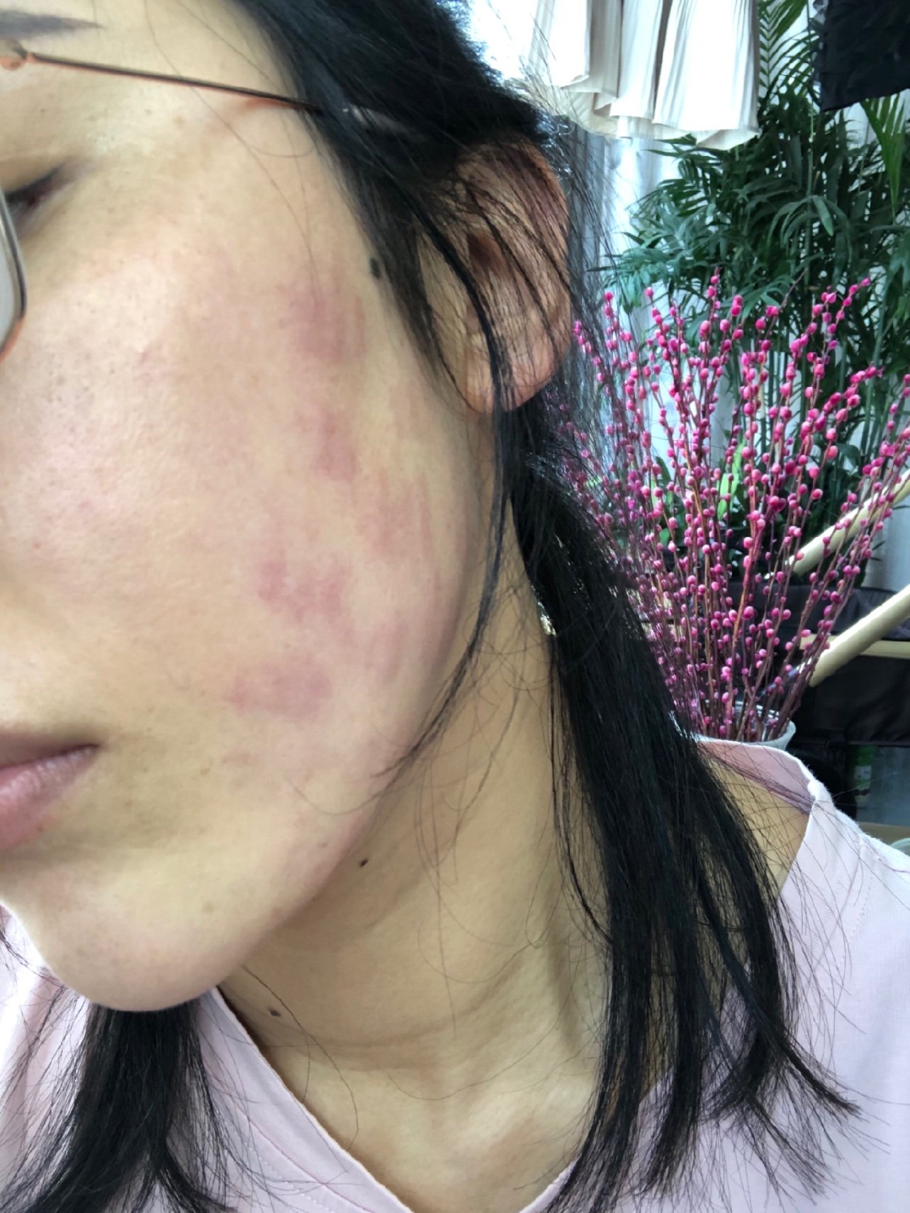 第四天了还是这样,有烫有痒,坑定是注射时非无菌操作_圈子-新氧美容