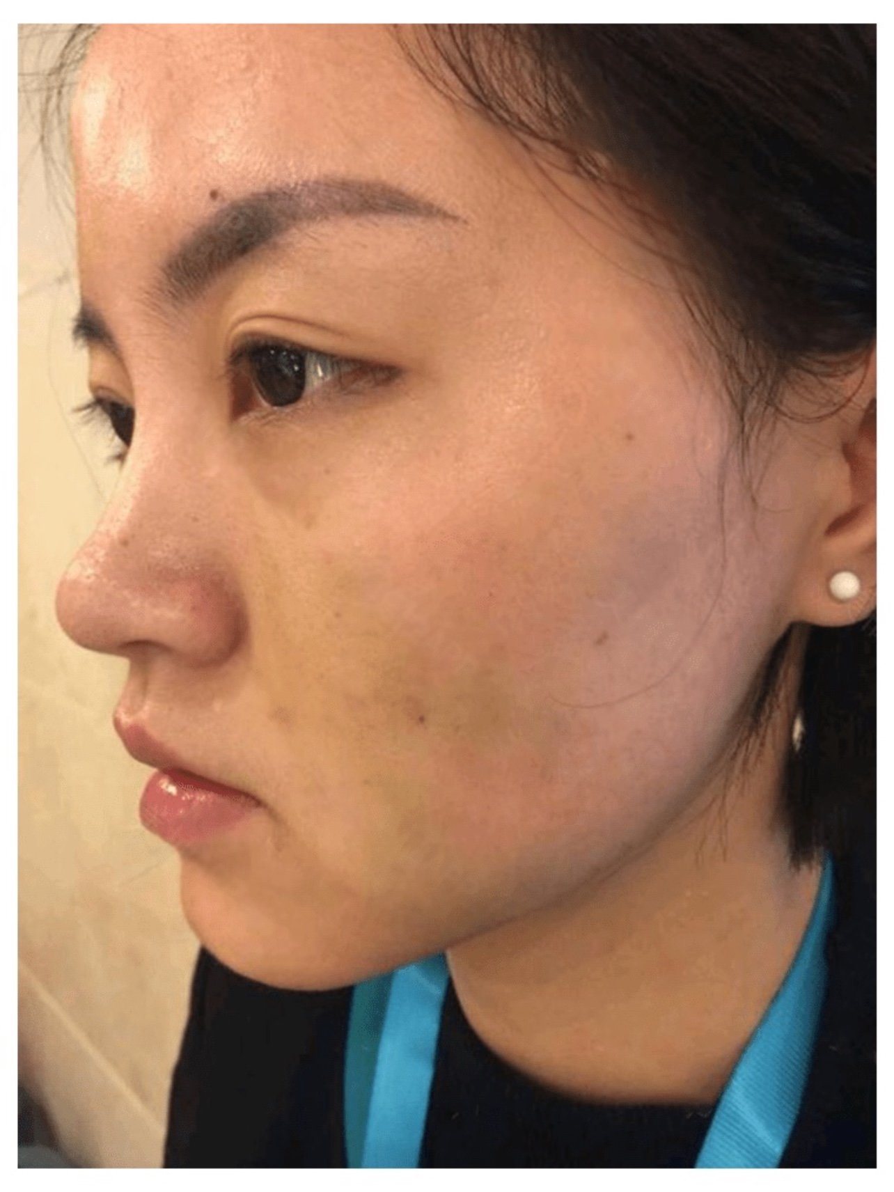 做过两次普通的光子嫩肤说一下感受和效果做的时候就像_圈子-新氧美容