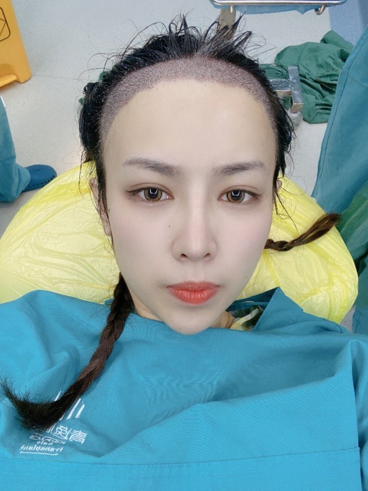 考虑了好久的植发际线终于咬咬牙做了~我发际线超级高_圈子-新氧美容