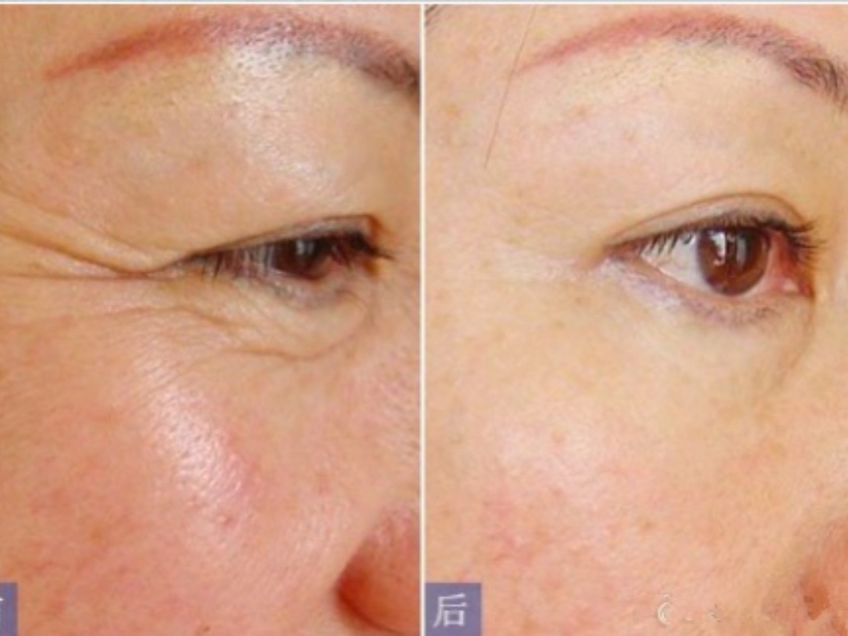 纠正眼部注射玻尿酸的效果是非常好的能够有效的减少眼睛周围的皱纹