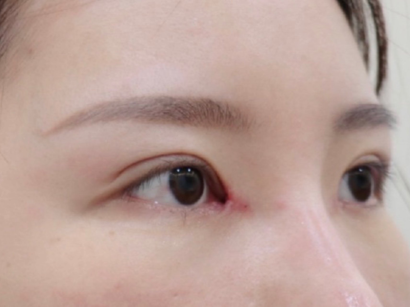 内眼角修复术后拆线