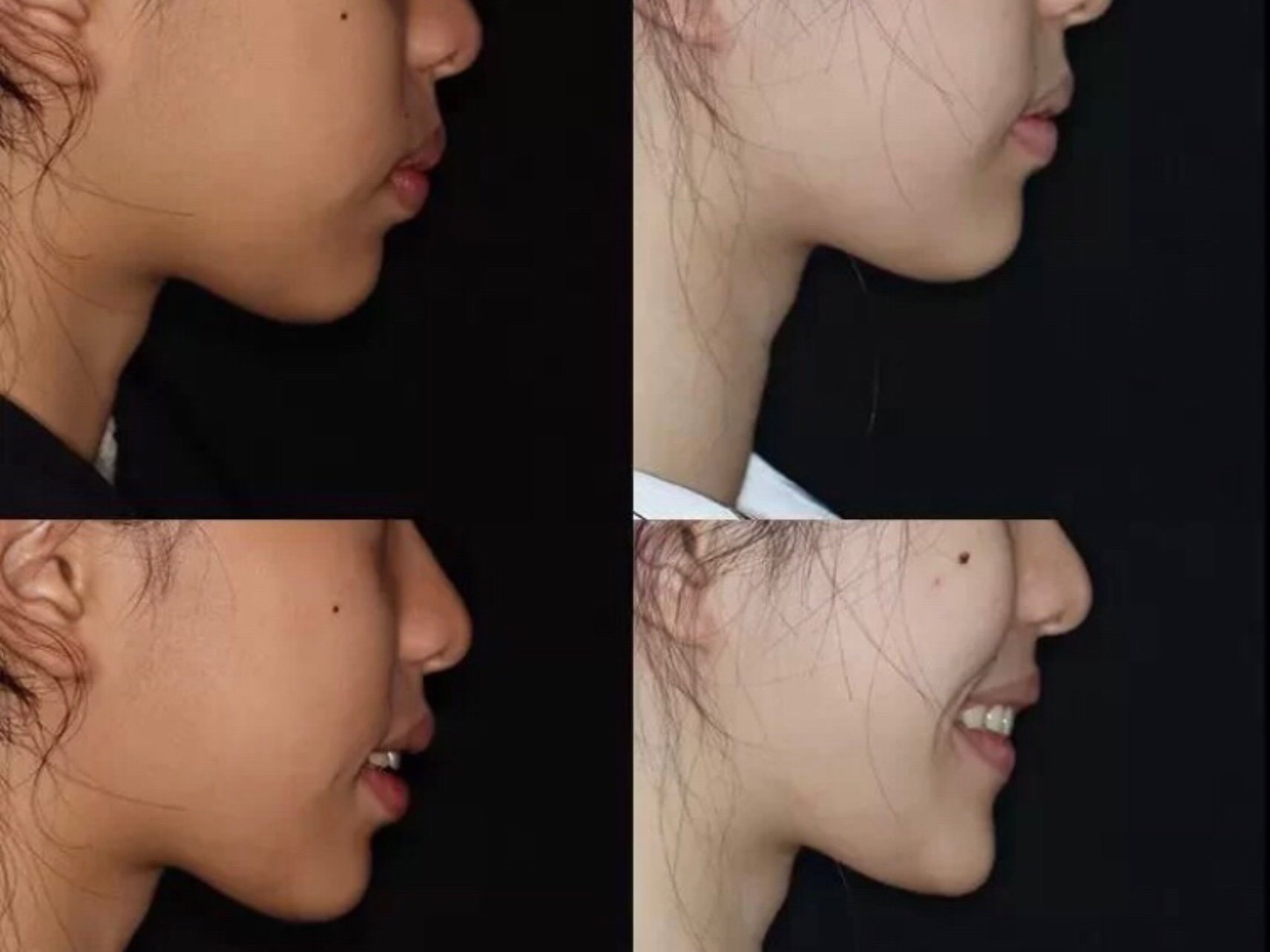 979797牙齿矫正案例 | 两年时间内收前牙▌矫正前后_圈子-新氧