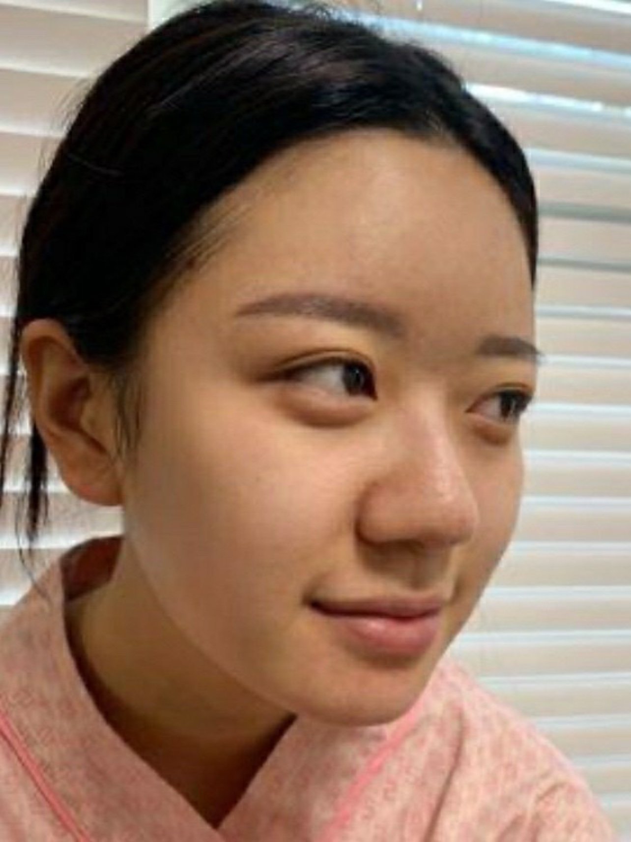 82蒜头鼻缩小有哪些方法风险大吗多少钱