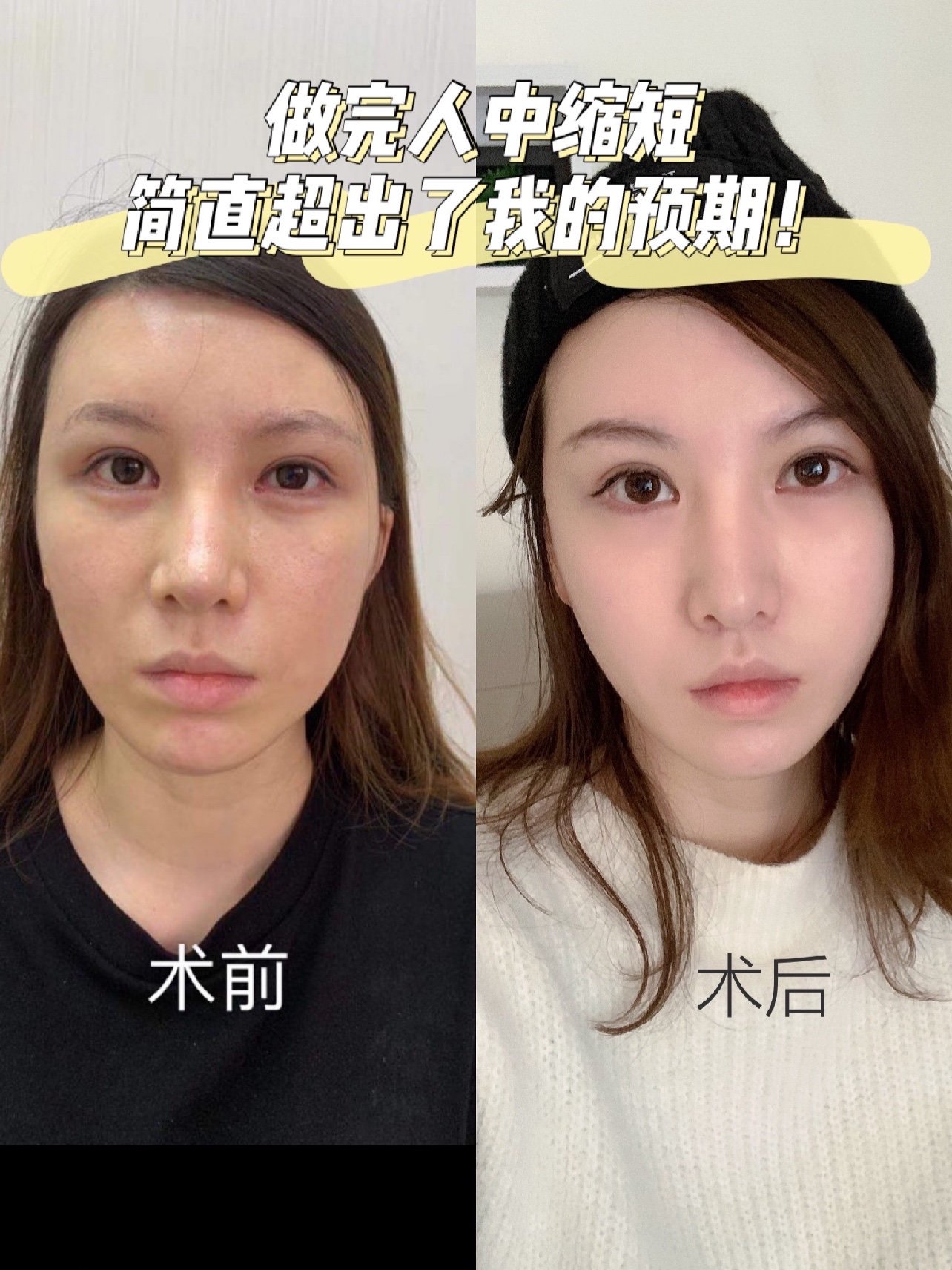 做完人中缩短简直超出了我的预期!