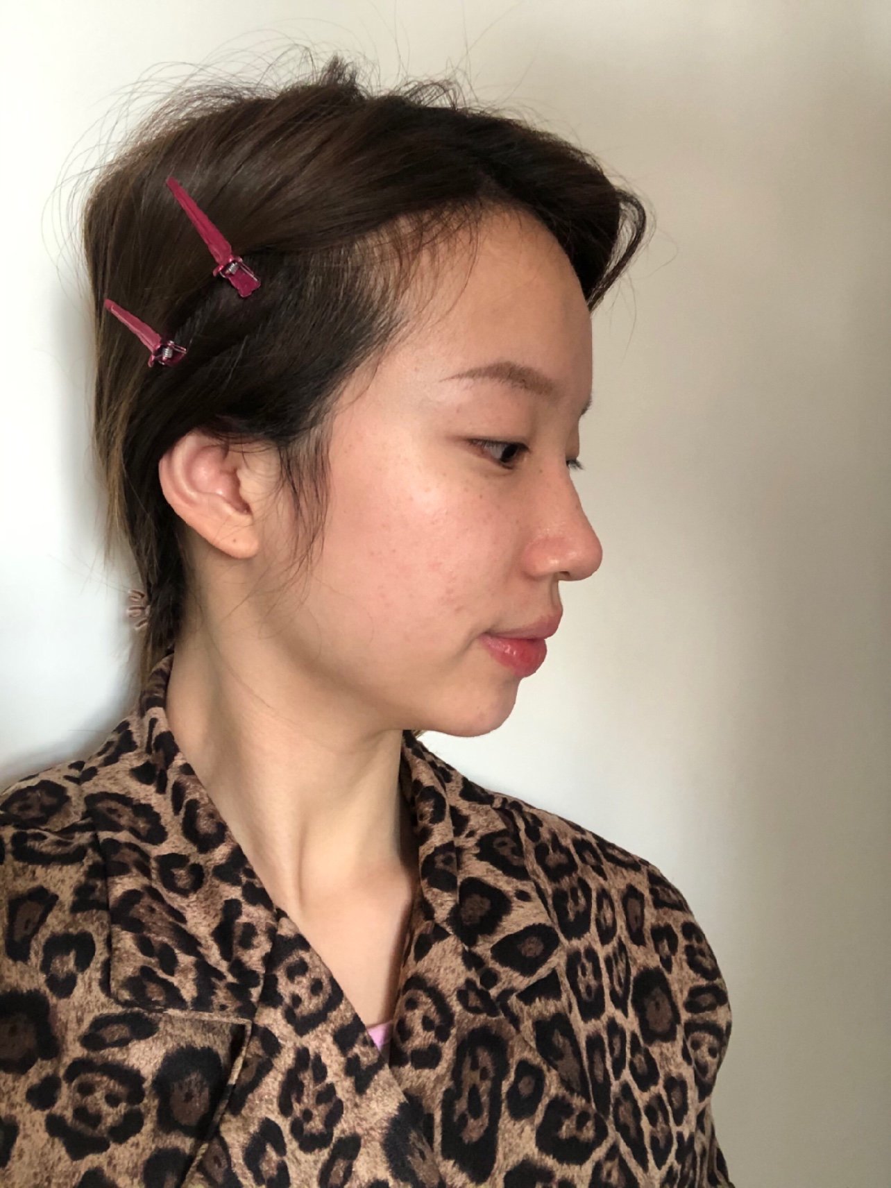 【达拉斯隆鼻第15天】