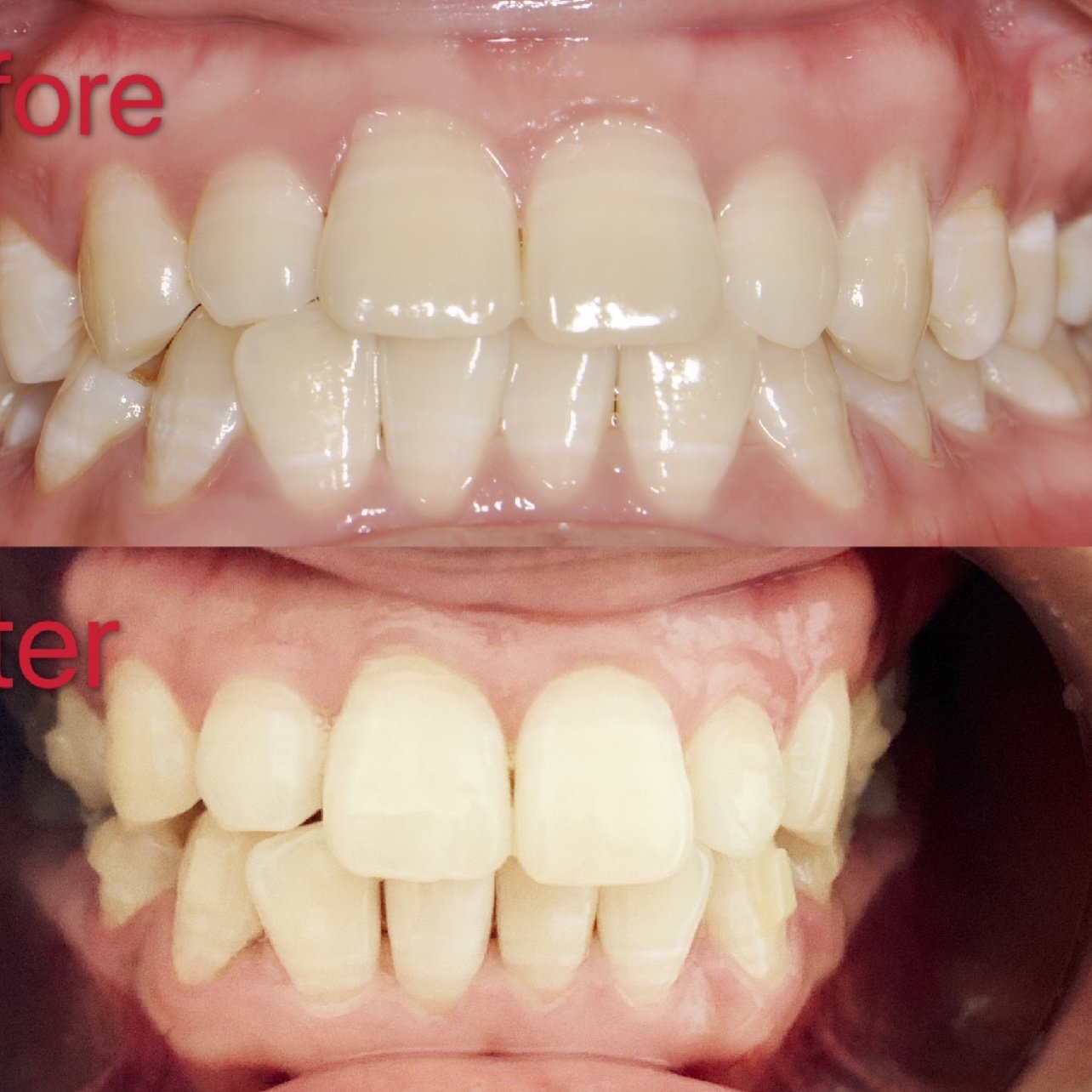 5月24日 心情忐忑的第三次复诊上次复诊牙齿片切之_圈子-新氧美容整形