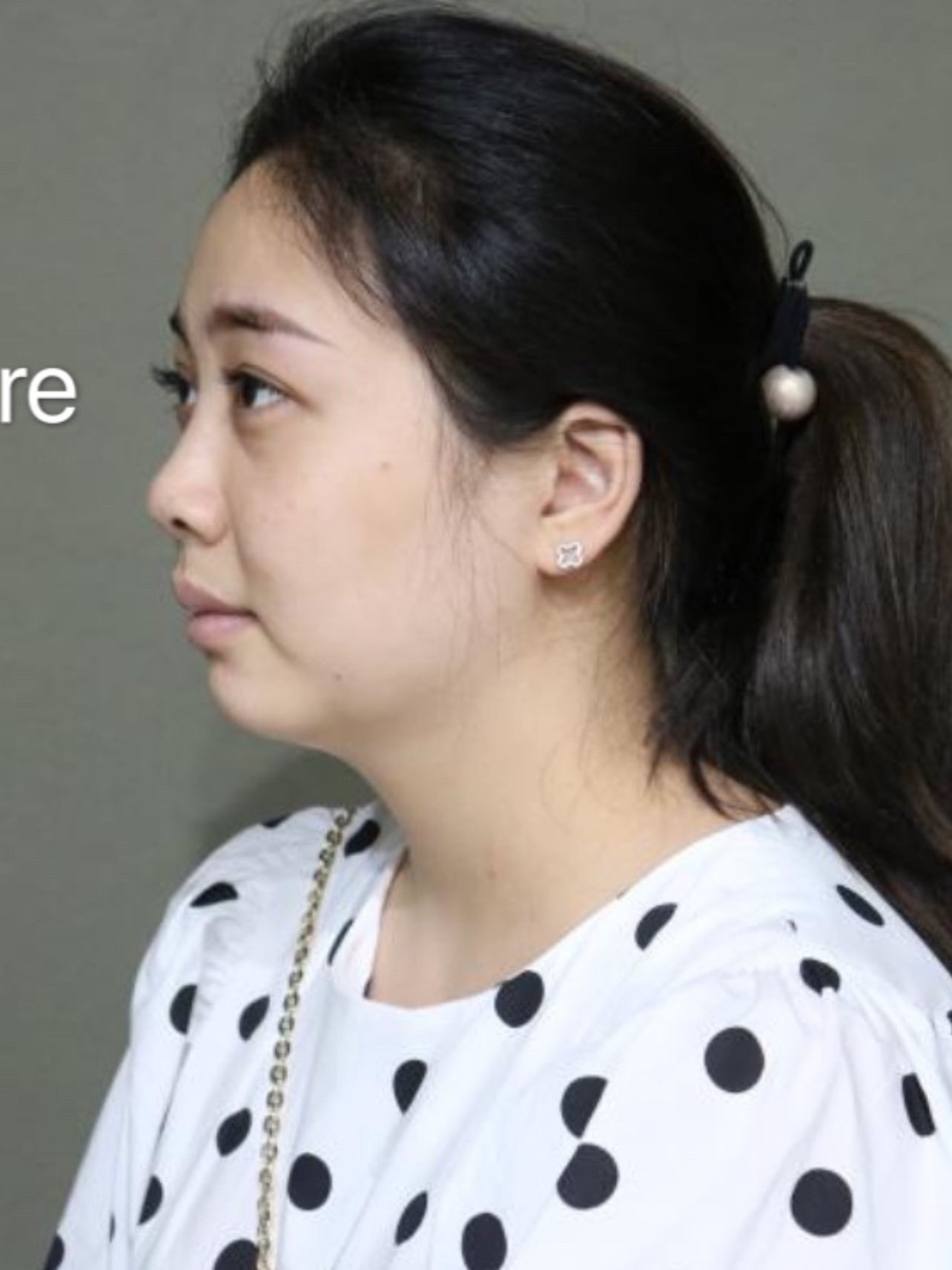 伊婉丰下巴 第158天