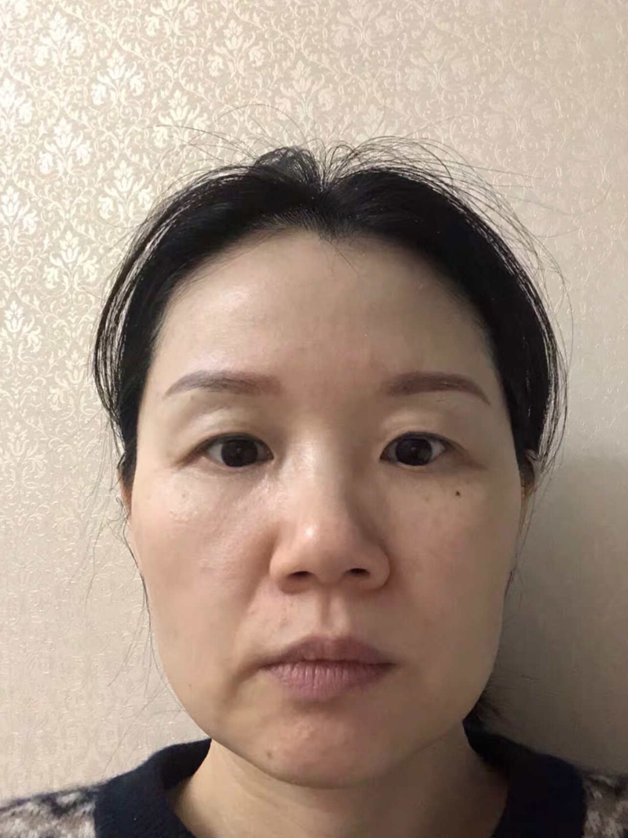 我是属于法令纹深,苹果肌下垂的那种.