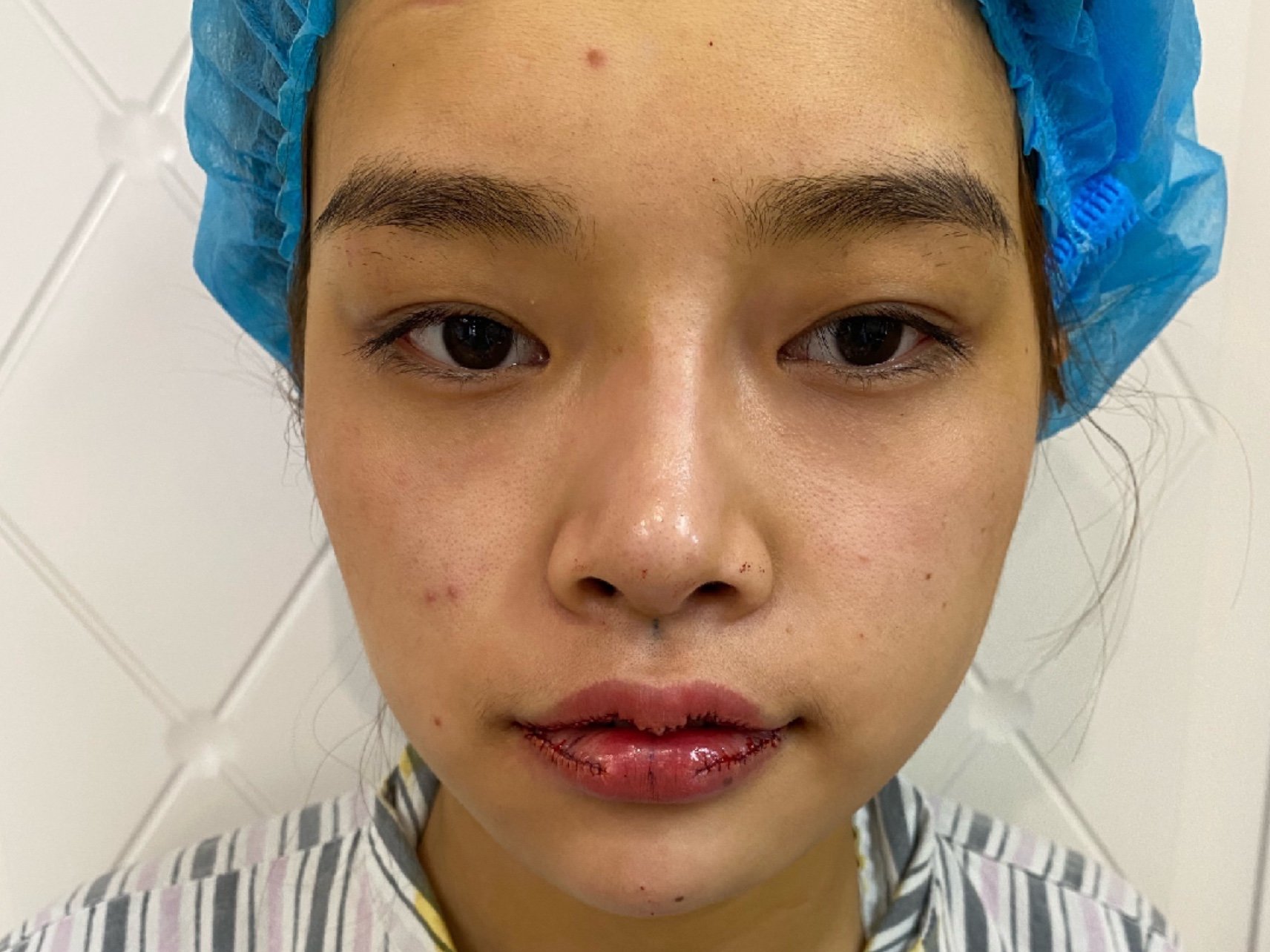 魅力唇部塑造术 #m唇6015今天是做_圈子-新氧美容整形