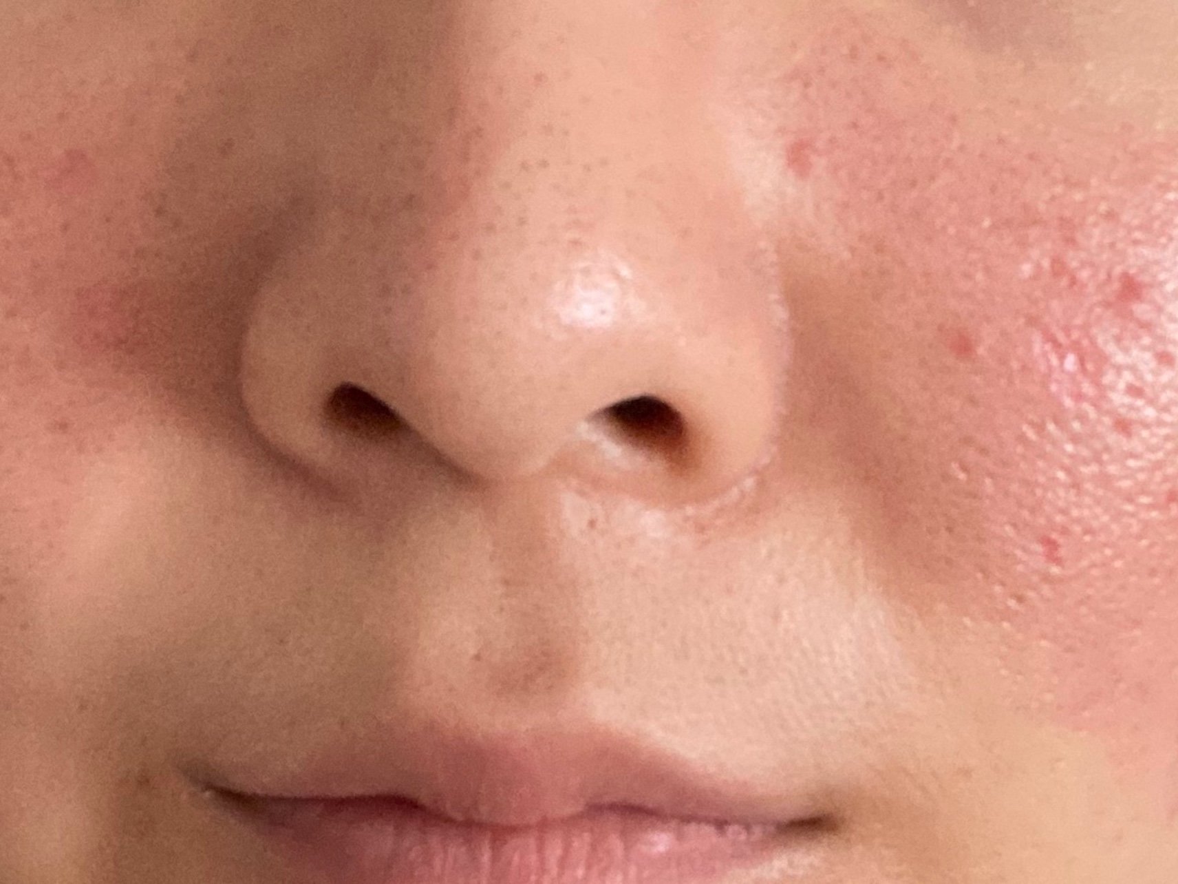 第九天 脸上痂全掉了