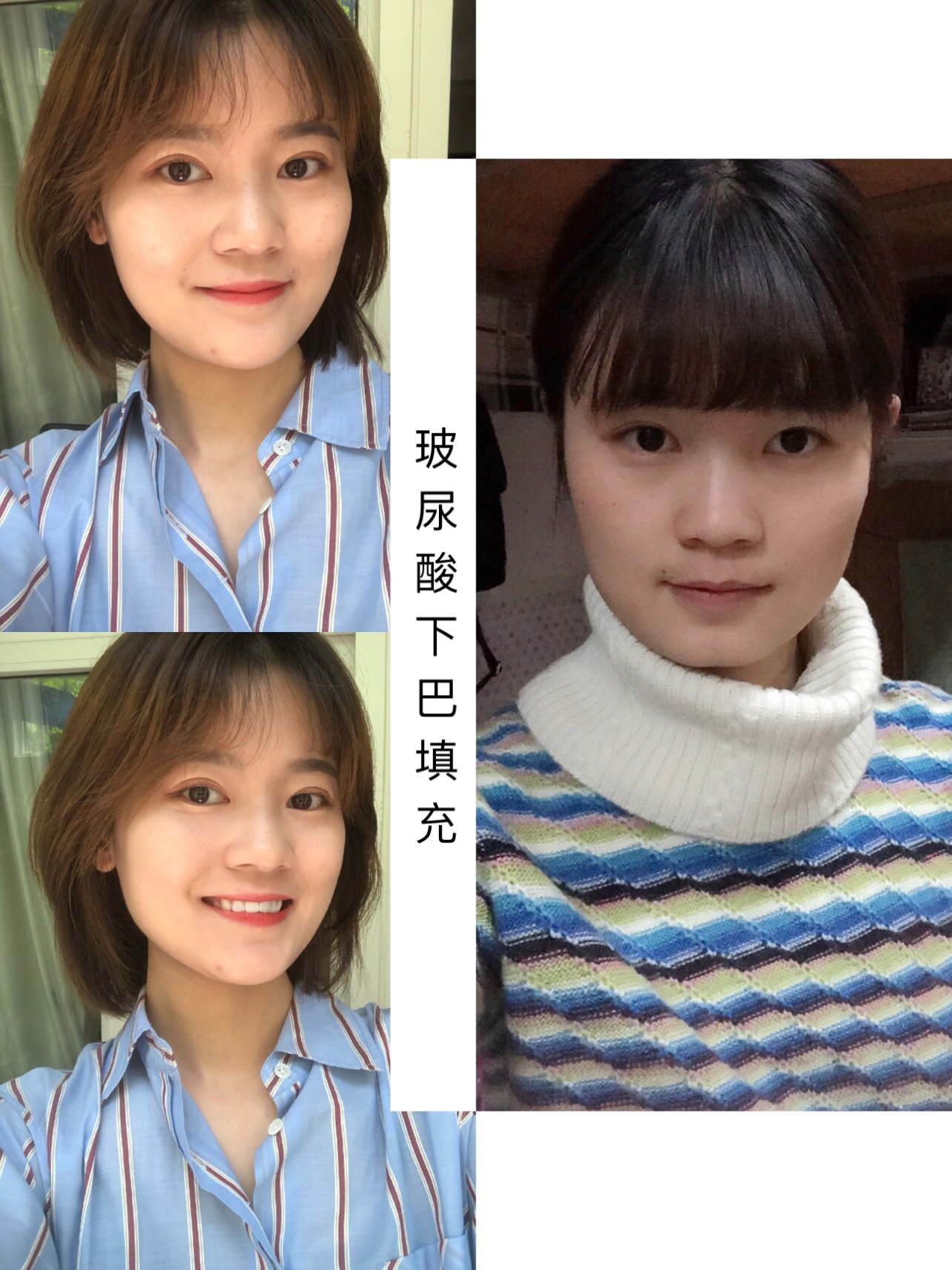 只想要改变下巴的形状,到要求自然微翘就好,沟通后,选择了玻尿酸填充