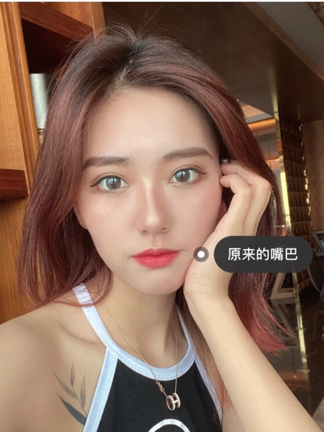 玻尿酸打嘟嘟唇,原本嘴角有点往下垂,注射玻尿酸不止嘴形变美了,嘴角