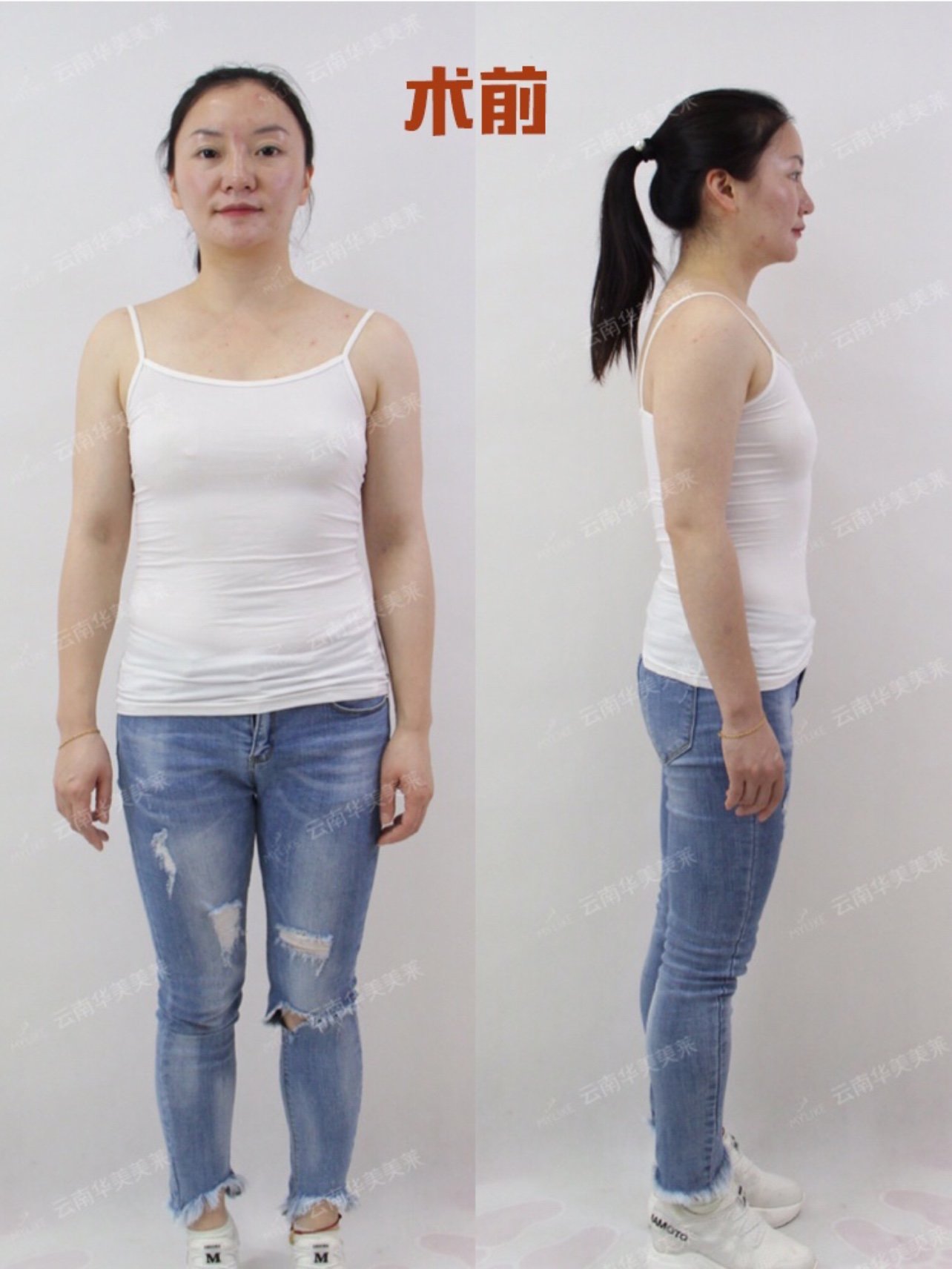 隆胸失败!真的就没救了吗?