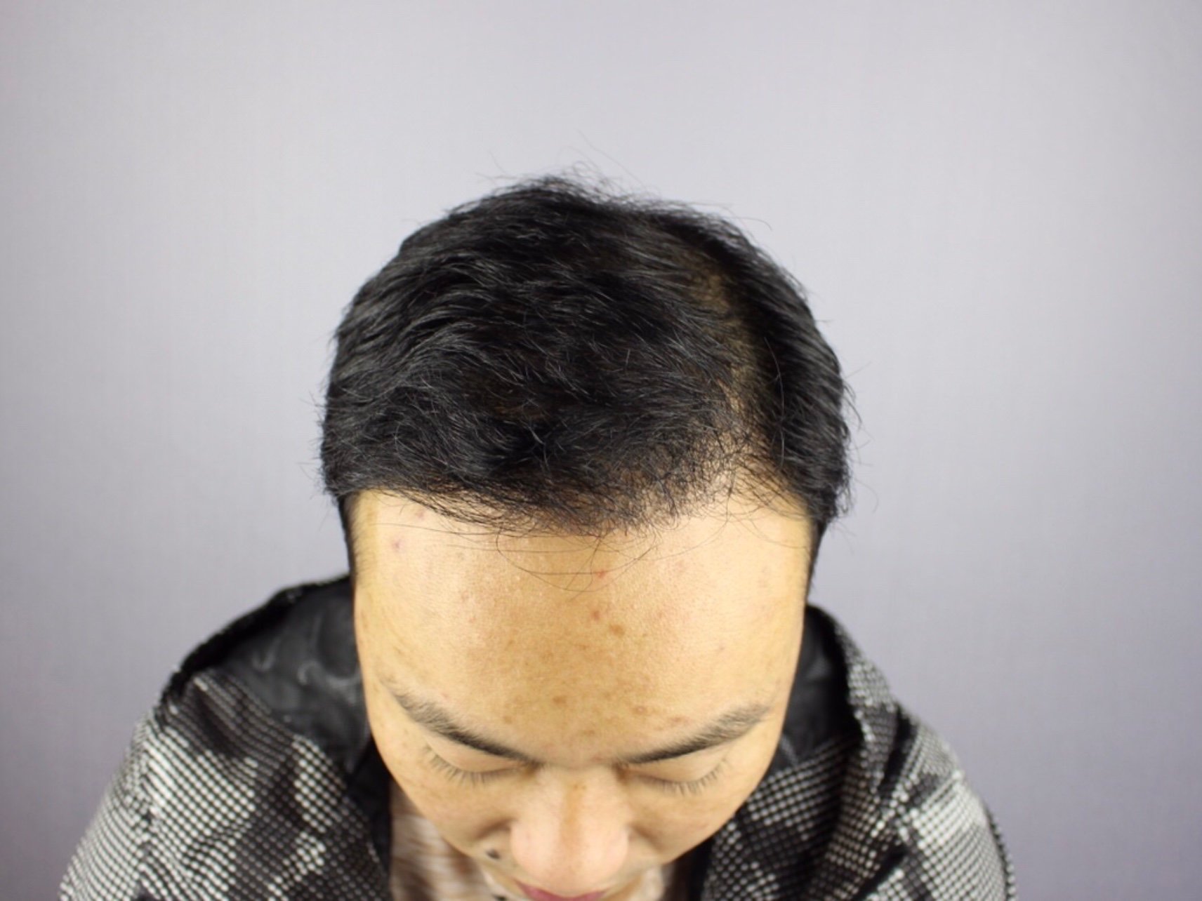 斑秃,俗称鬼剃头, 是一种比较特殊的脱发,患者头顶突然出现圆形或
