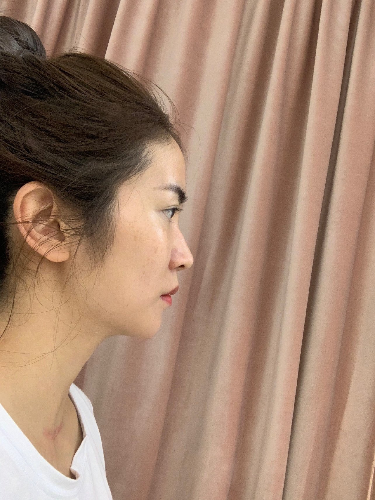 魔镜测脸 一直想做假体下巴,去年8月打的玻尿酸,_圈子-新氧美容整形