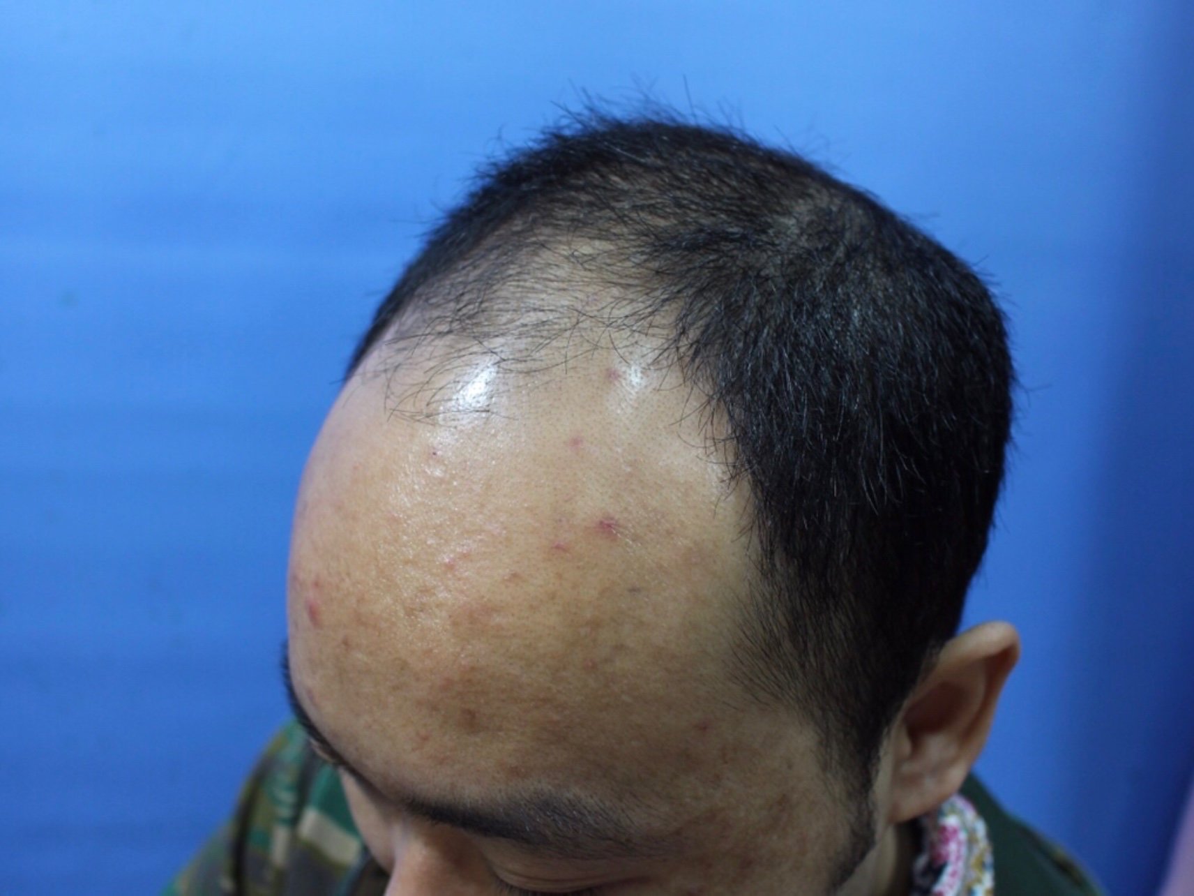 斑秃,俗称鬼剃头, 是一种比较特殊的脱发,患者头顶突然出现圆形或