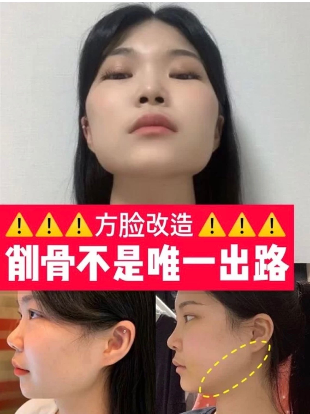 方形就必须削骨也不一定