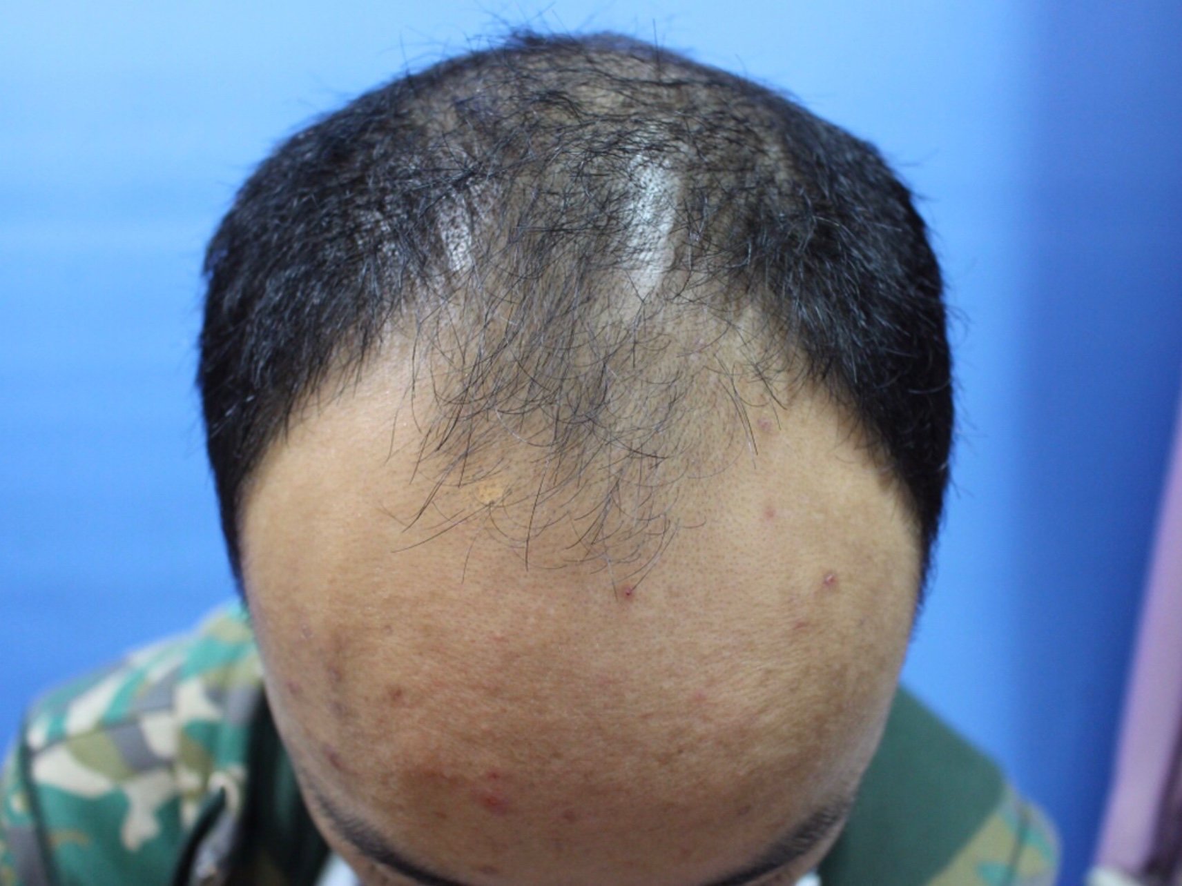 斑秃,俗称鬼剃头, 是一种比较特殊的脱发,患者头