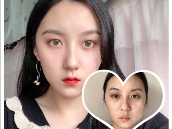 前和术后的嘴唇做了一个对比照,0909是不是变_圈子-新氧美容整形